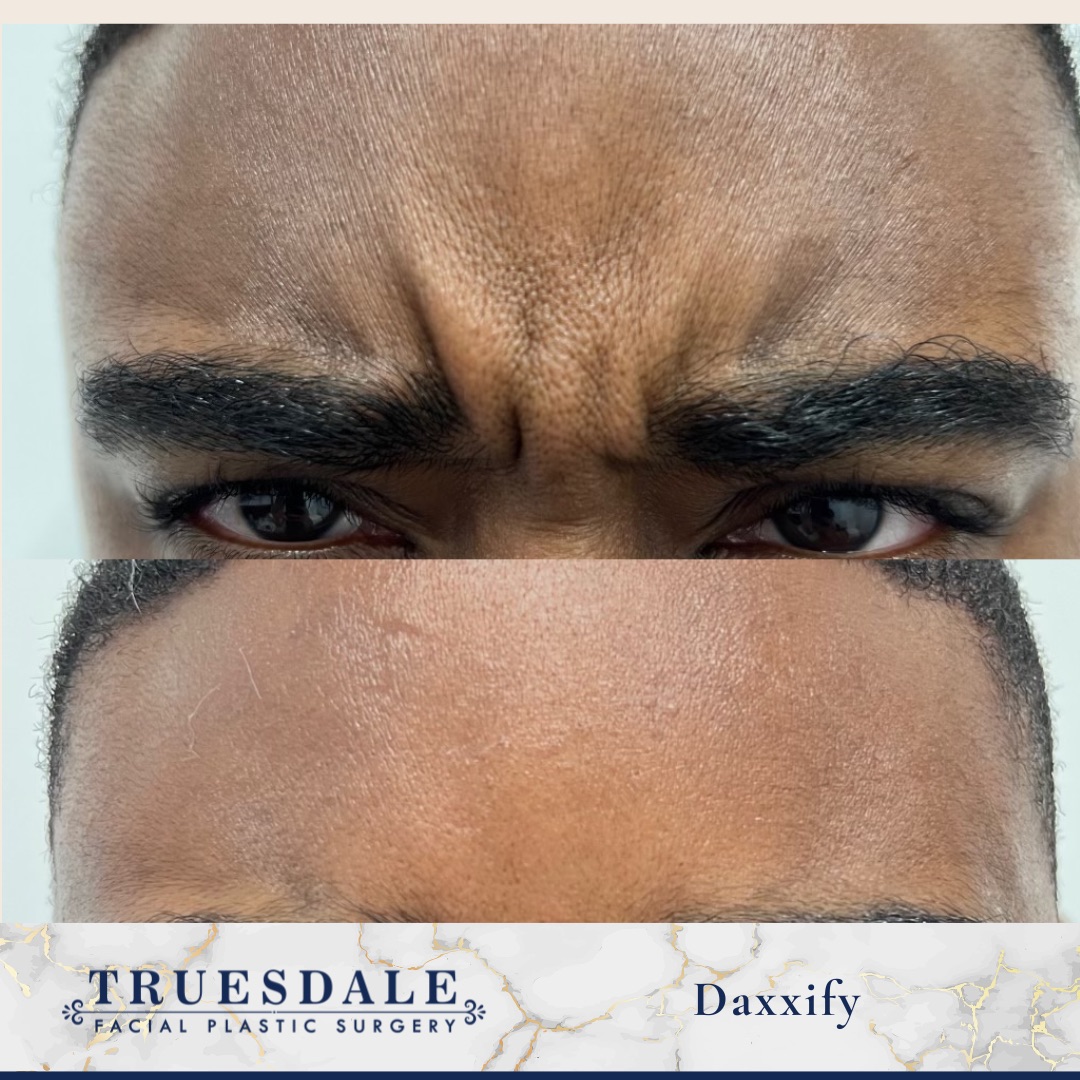 Botox and Jeuveau before and after — frown lines ("11s") softened between the brows · before and after composite