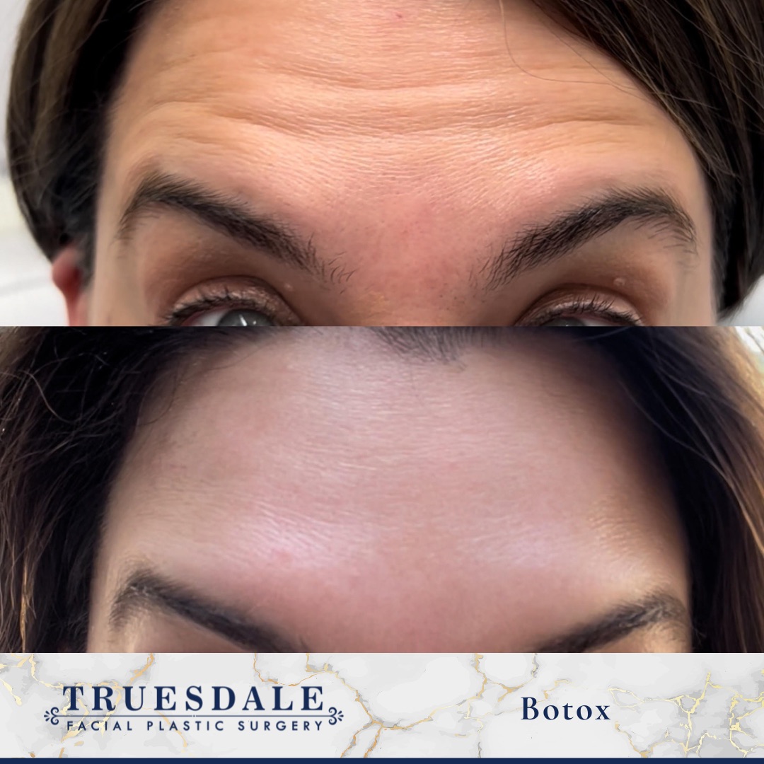 Botox before and after — forehead expression lines relaxed · before and after composite