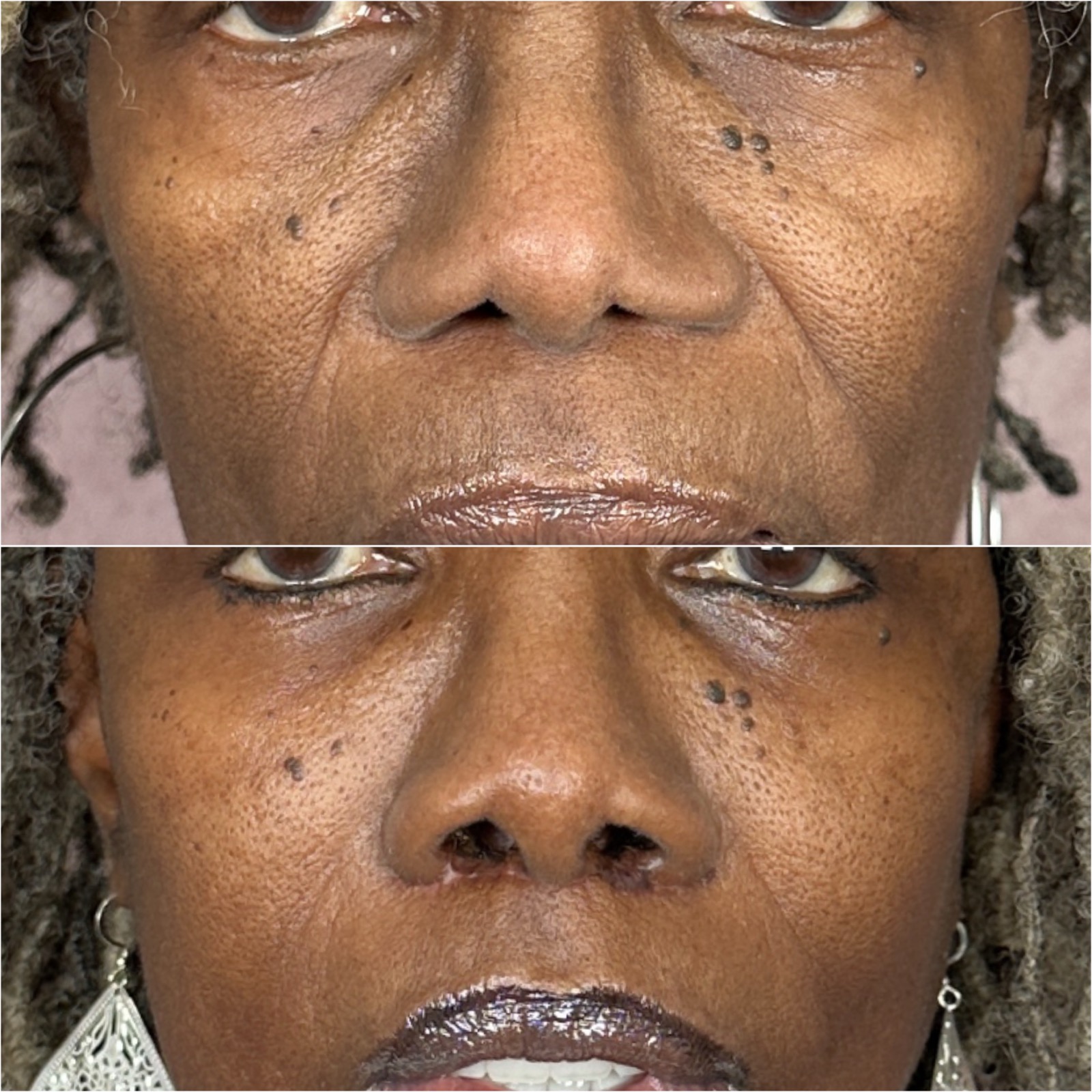 Alarplasty before and after &mdash; nostril refinement · before and after composite