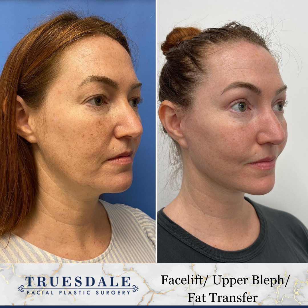 Before and after — facelift, upper bleph & fat transfer, oblique
