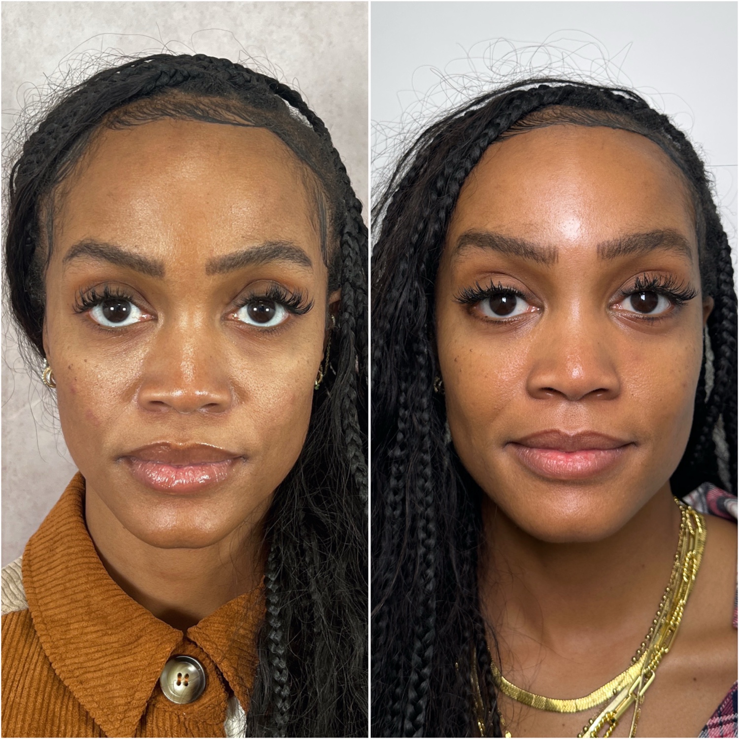 Lower blepharoplasty + fat transfer before and after · before and after composite