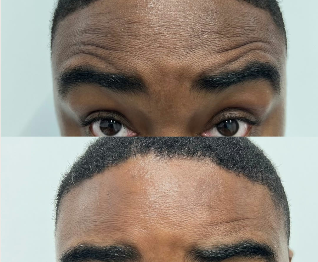 Before and after &mdash; Daxxify &mdash; Forehead Lines · before and after composite