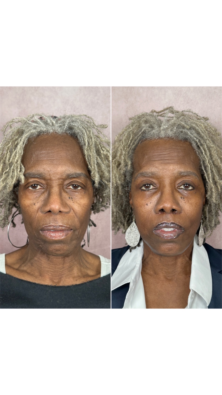 Brow lift before and after · frontal view