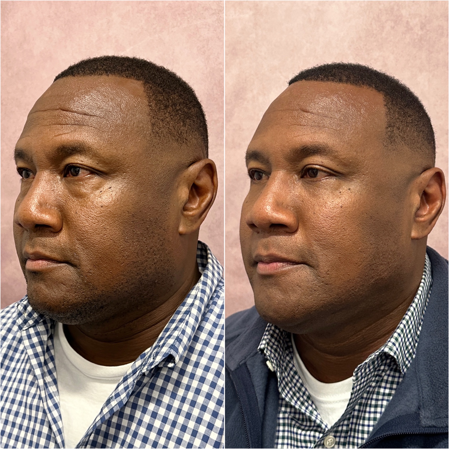 Before and after &mdash; male brow lift and lower blepharoplasty, oblique view