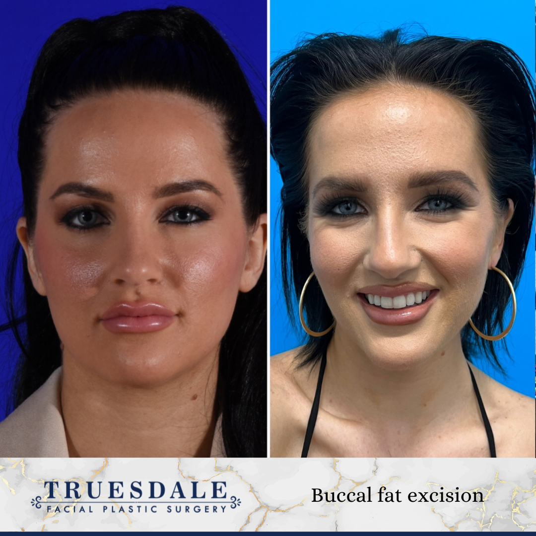 Buccal fat removal before and after &mdash; featured patient · before and after composite