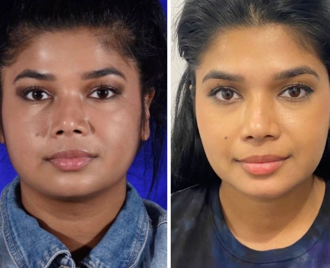 Chin augmentation before and after &mdash; featured patient · frontal view
