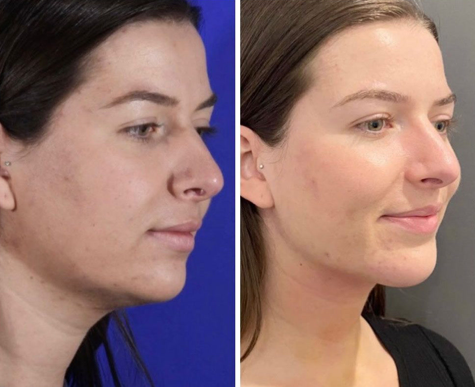 Chin implant + neck liposuction before and after, oblique view