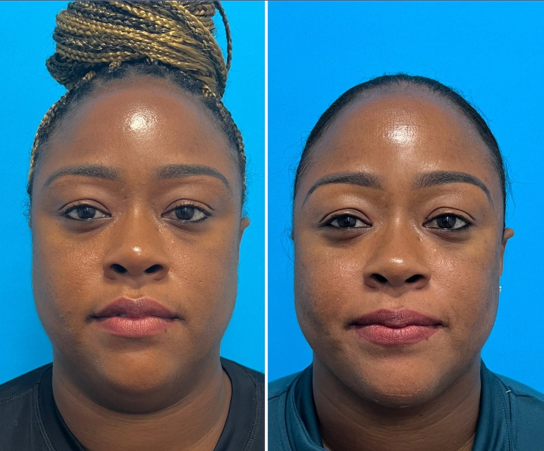 Before and after &mdash; neck liposuction and FaceTite · before and after composite
