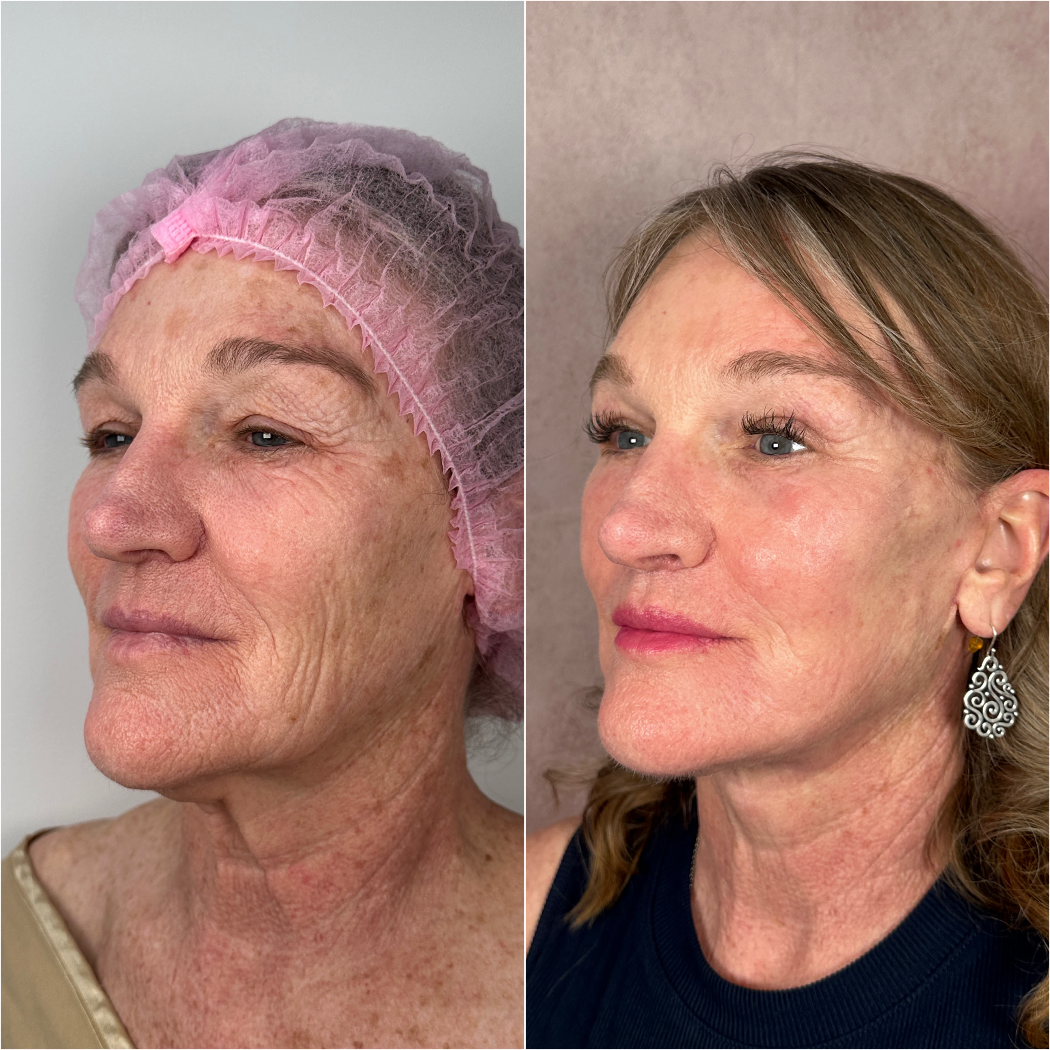 CO2 laser resurfacing before and after &mdash; featured patient · before and after composite