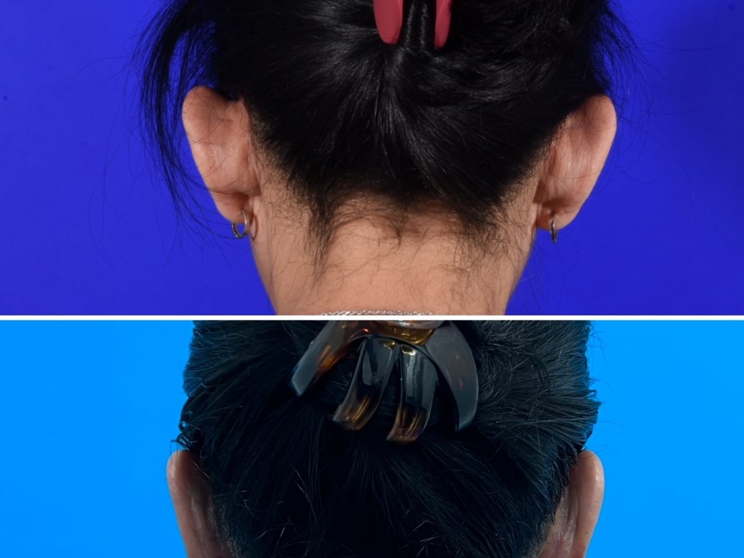 Otoplasty before and after &mdash; posterior view