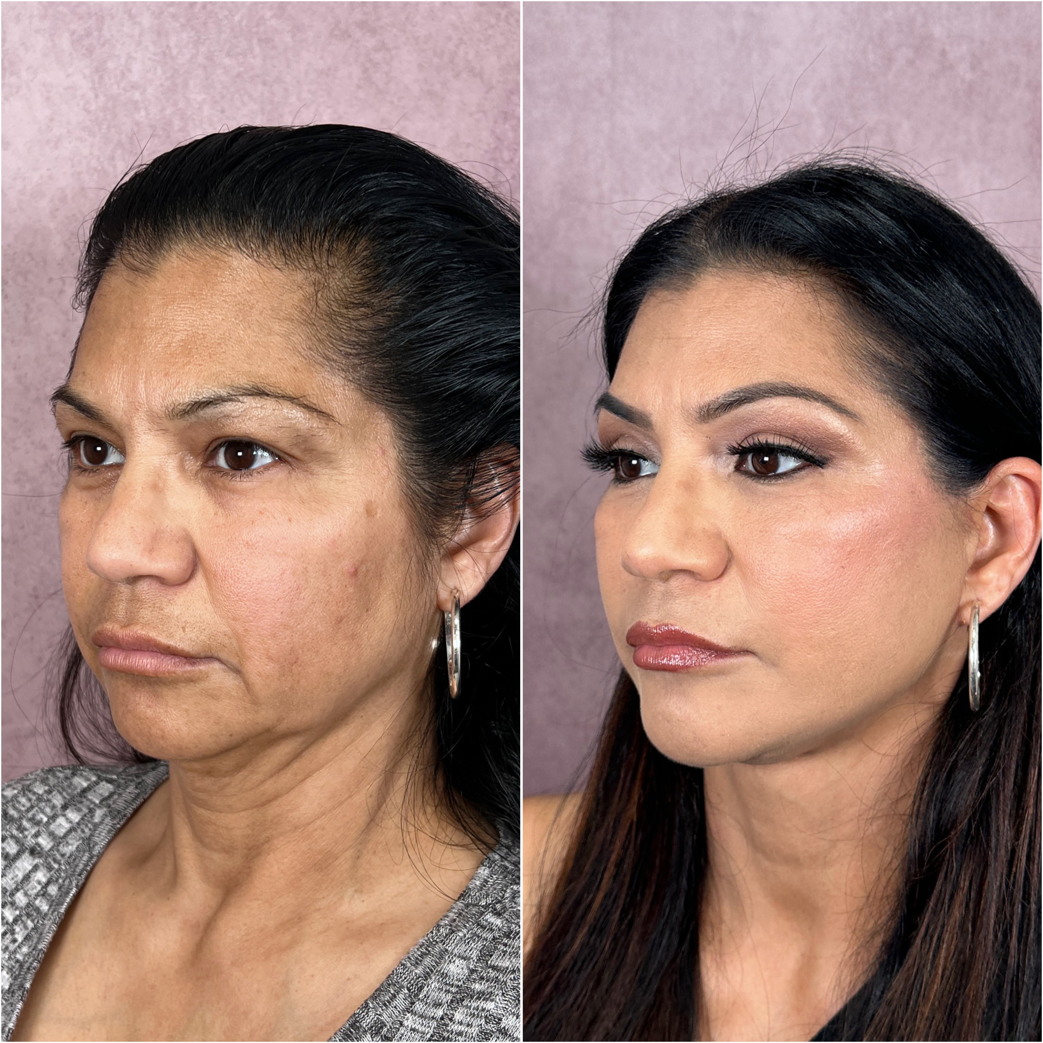 Facelift featured patient — Deep Plane Face & Neck Lift, Upper Blepharoplasty before and after · before and after composite