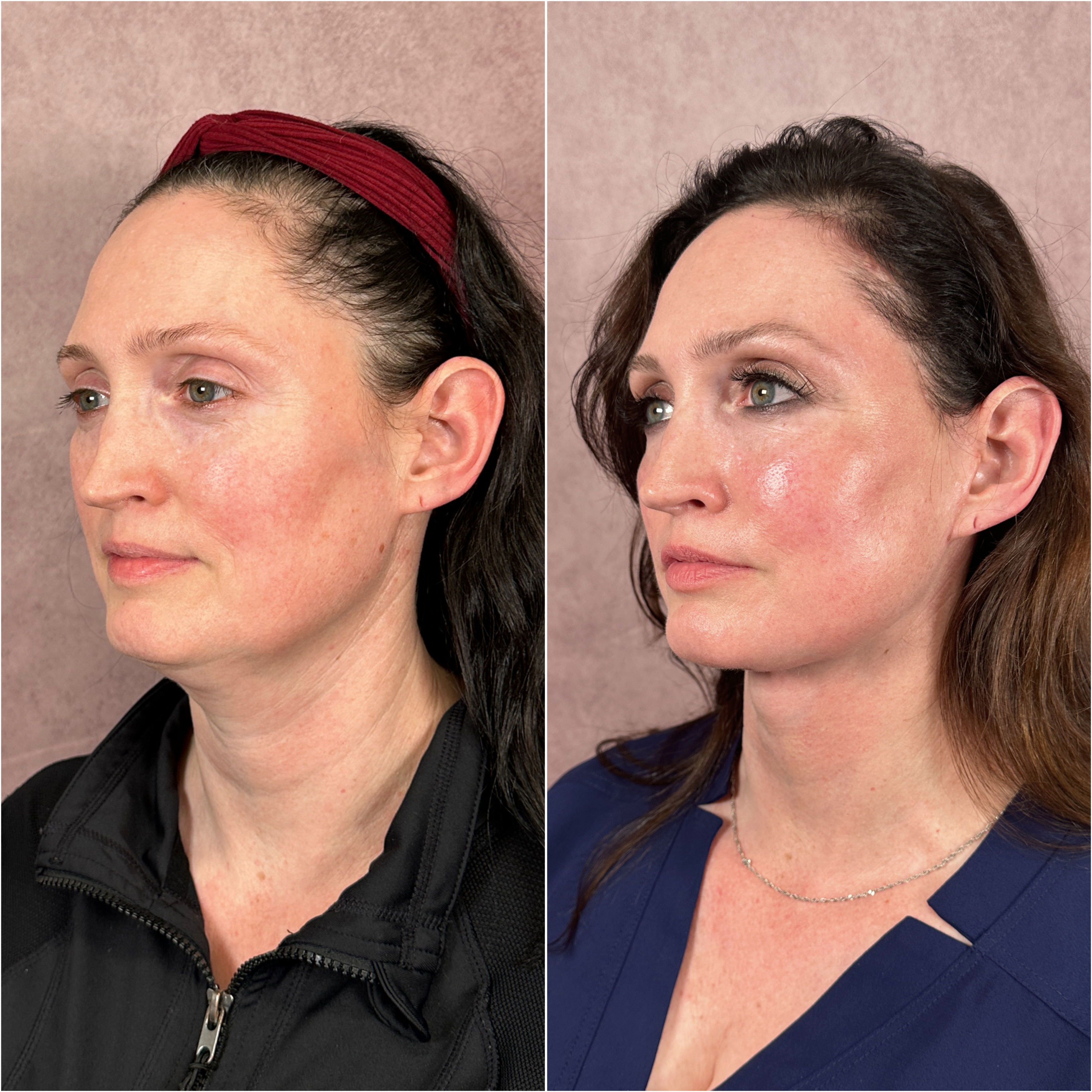 Before and after &mdash; The Masterpiece Surgery&trade;, oblique view
