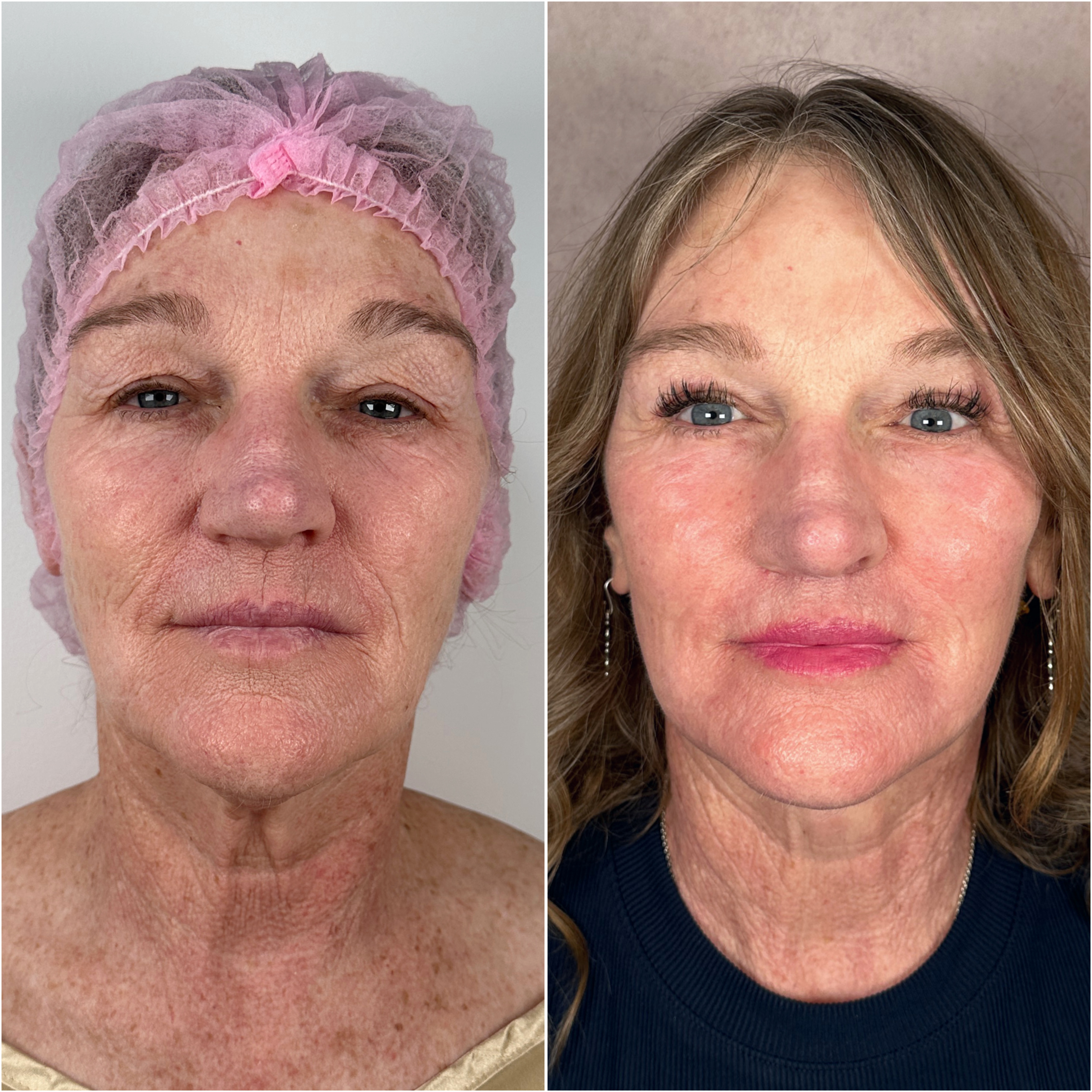 Before and after &mdash; facelift and neck lift, frontal view