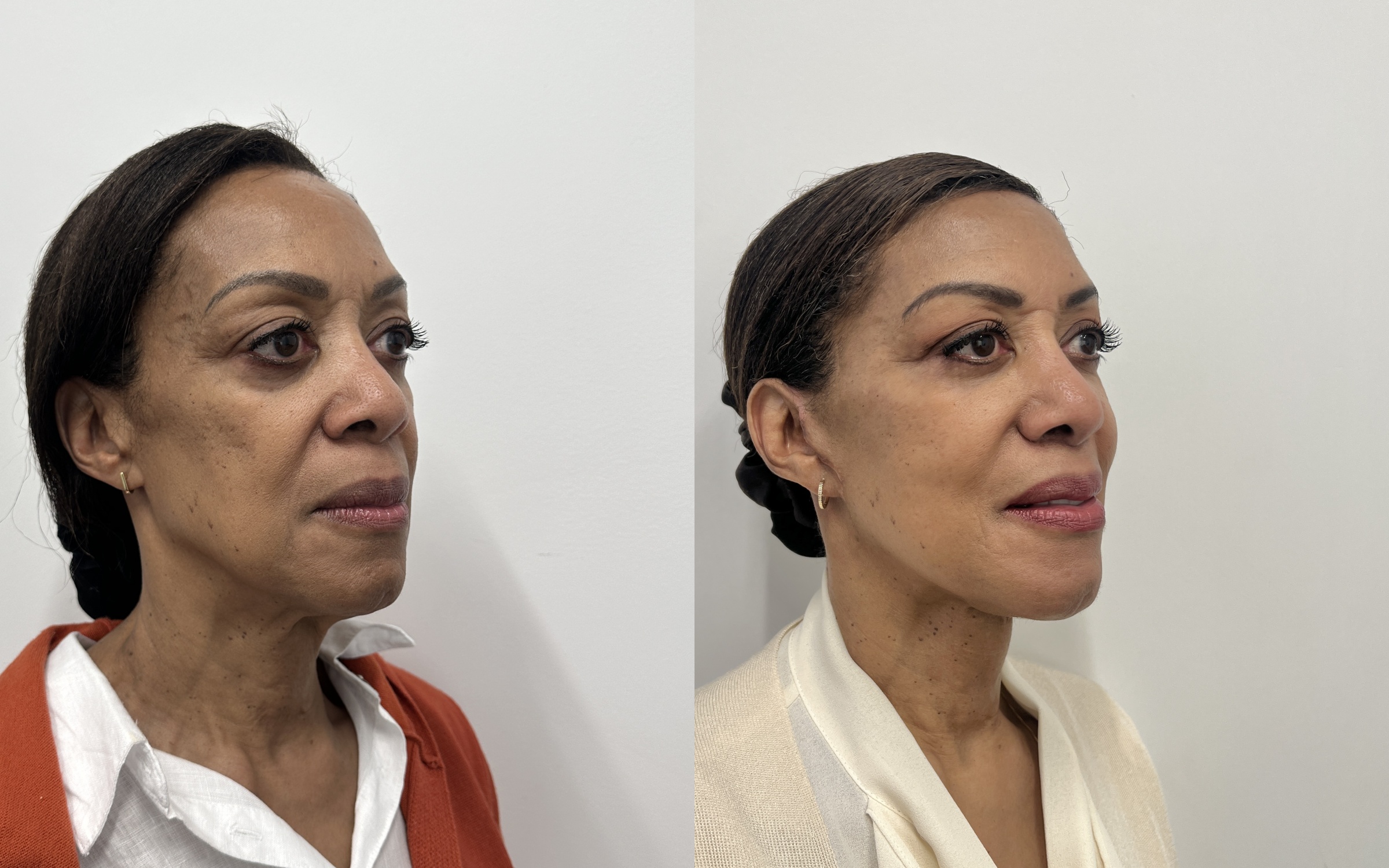 Before and after — deep plane facelift, oblique view