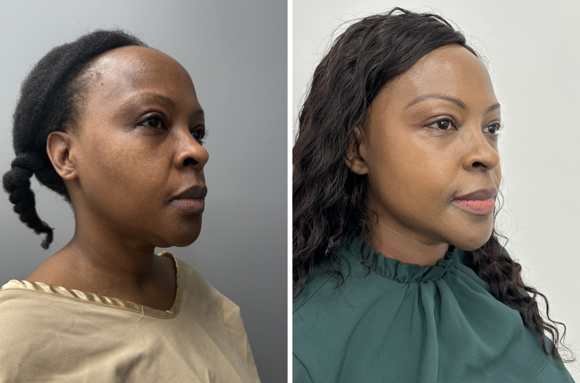 Before and after — deep plane facelift, oblique view
