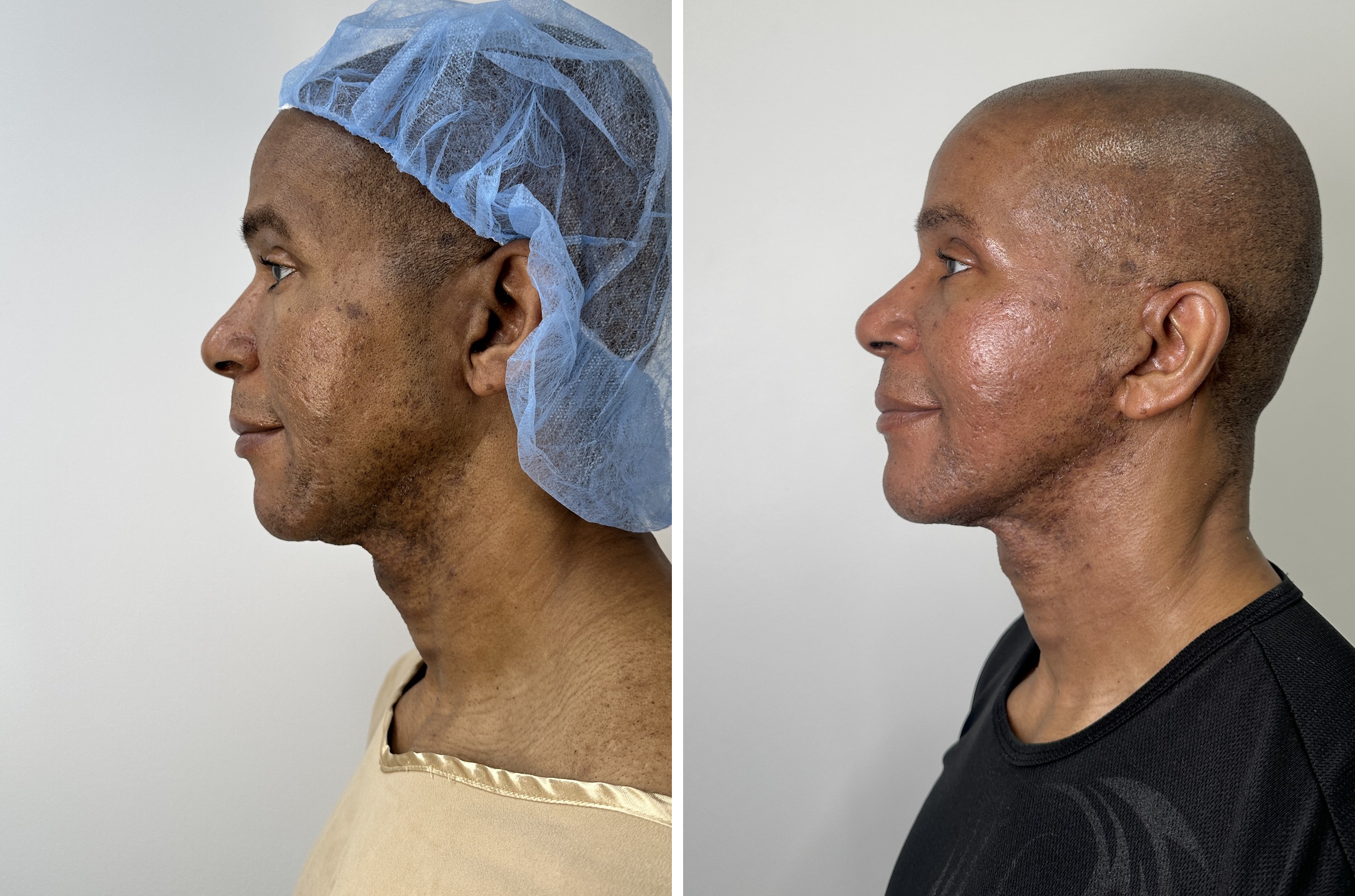 Before and after — male deep plane facelift, profile view
