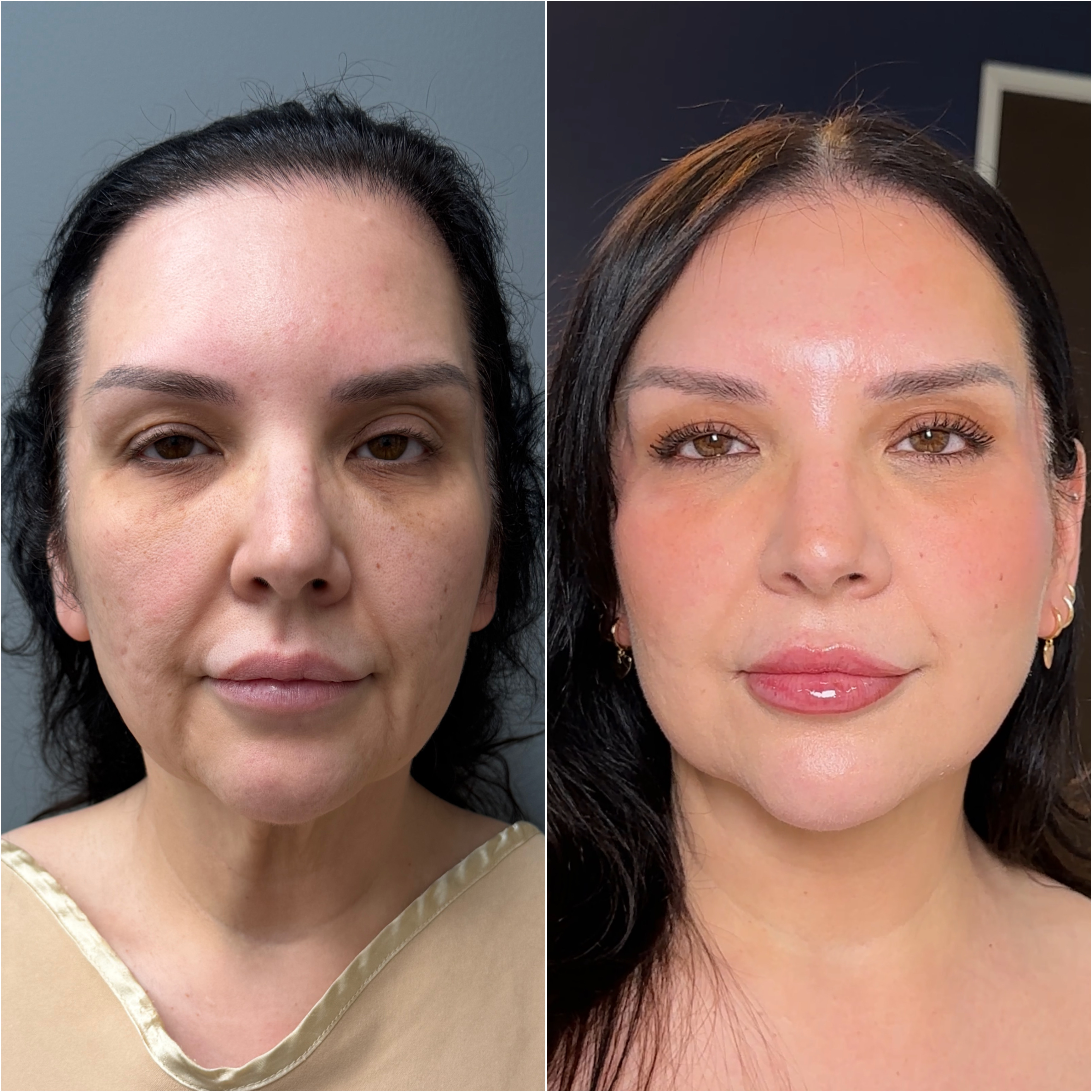 Facelift + Neck Lift + Fat Transfer before and after · before and after composite