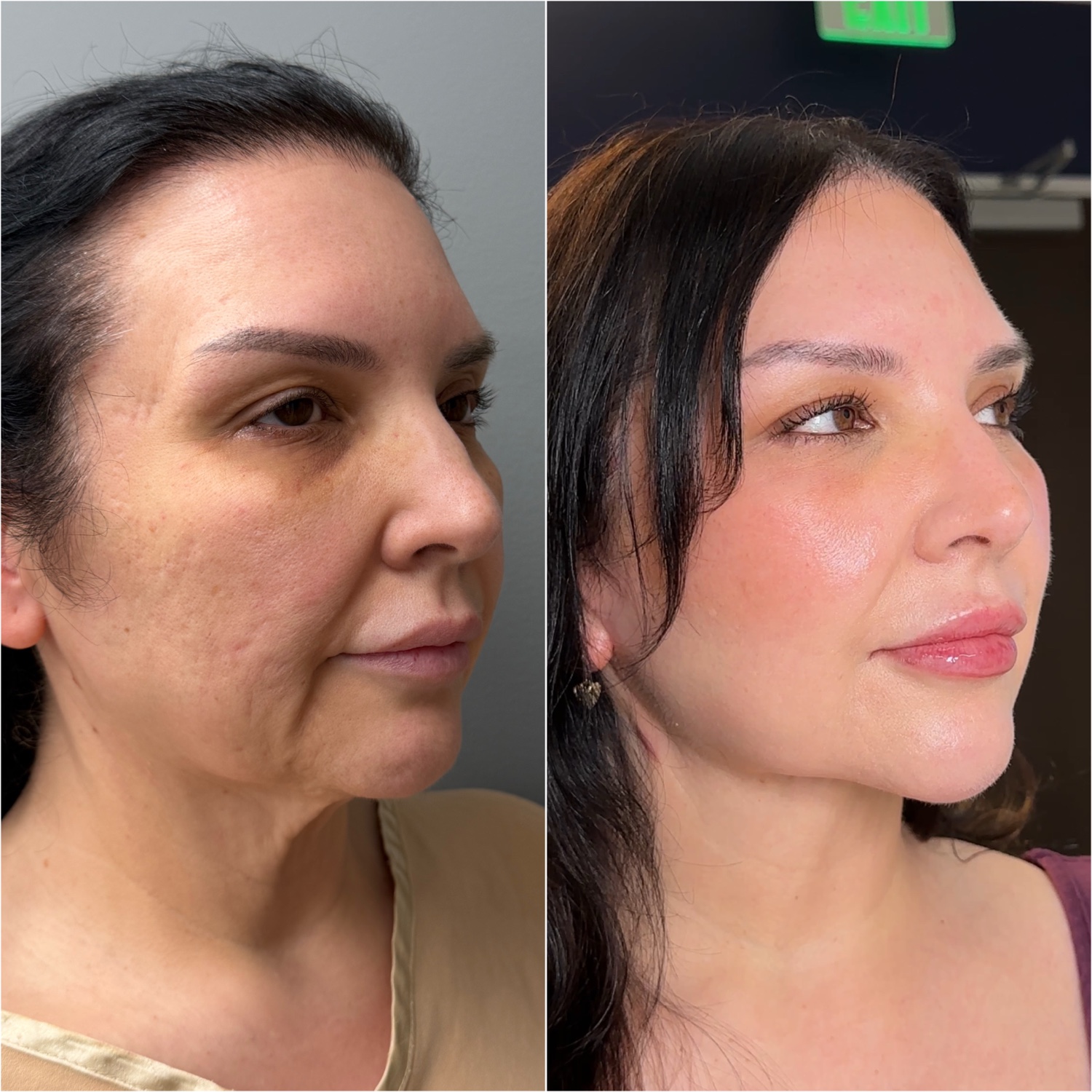 Before and after &mdash; facelift, neck lift, and fat transfer, profile view