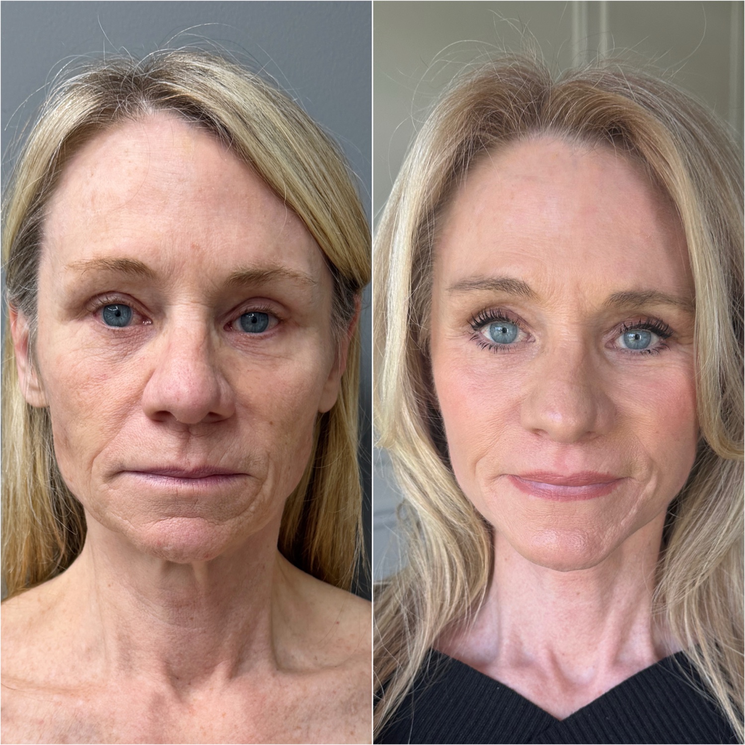 Facelift + Neck Lift + CO2 Laser before and after · frontal view