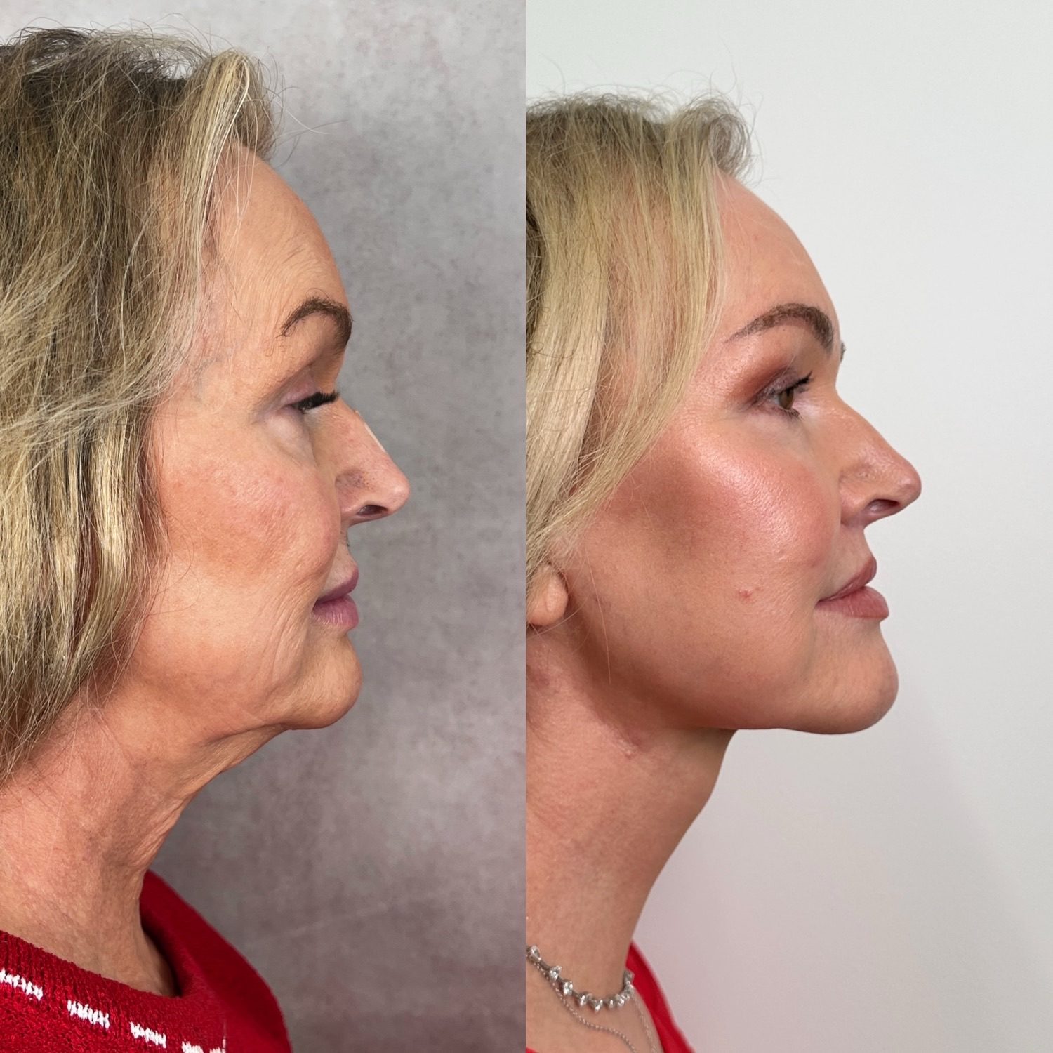 Before and after &mdash; facelift and neck lift as part of The Masterpiece Surgery&trade; with brow lift, upper blepharoplasty, lower lid skin pinch, lip lift, fat transfer and CO2 laser resurfacing, profile view