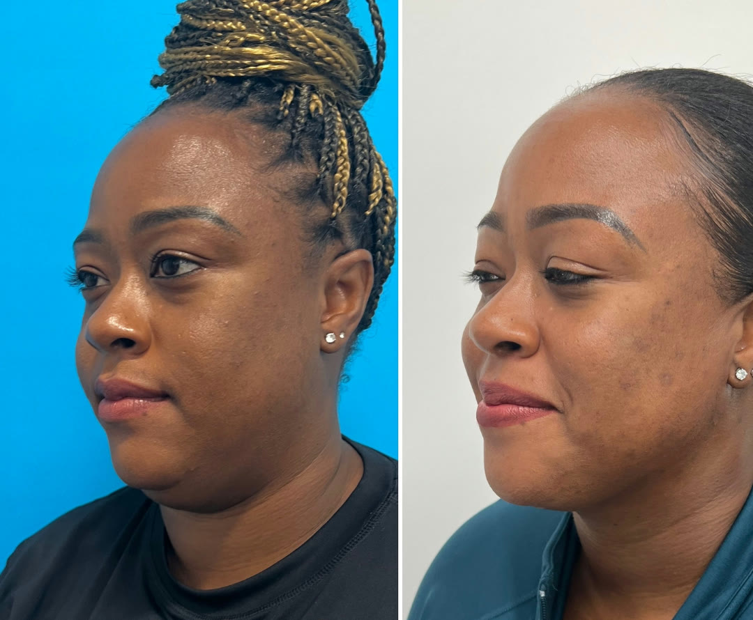 Neck liposuction with FaceTite before and after · before and after composite