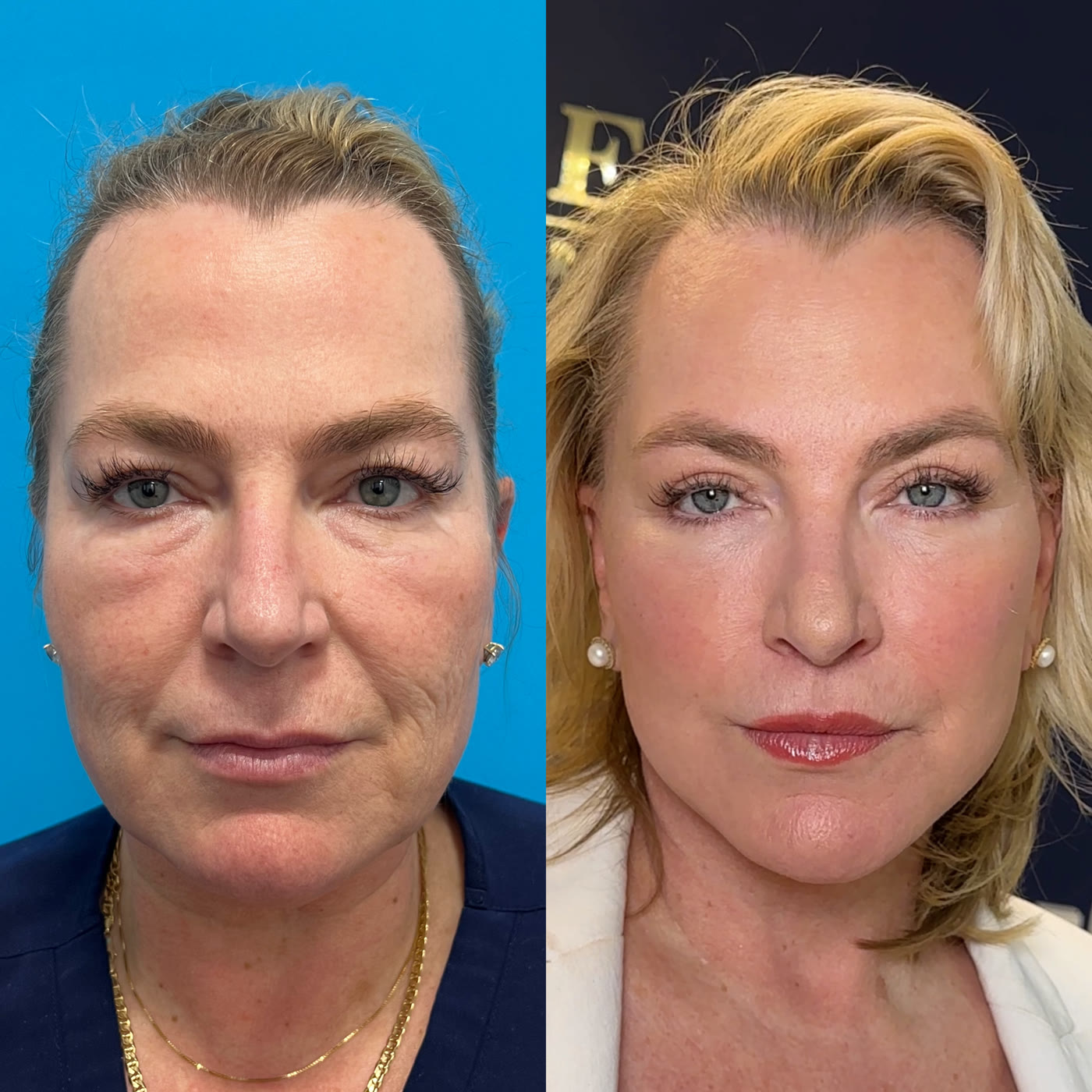 Lip Lift &mdash; featured patient before and after · before and after composite