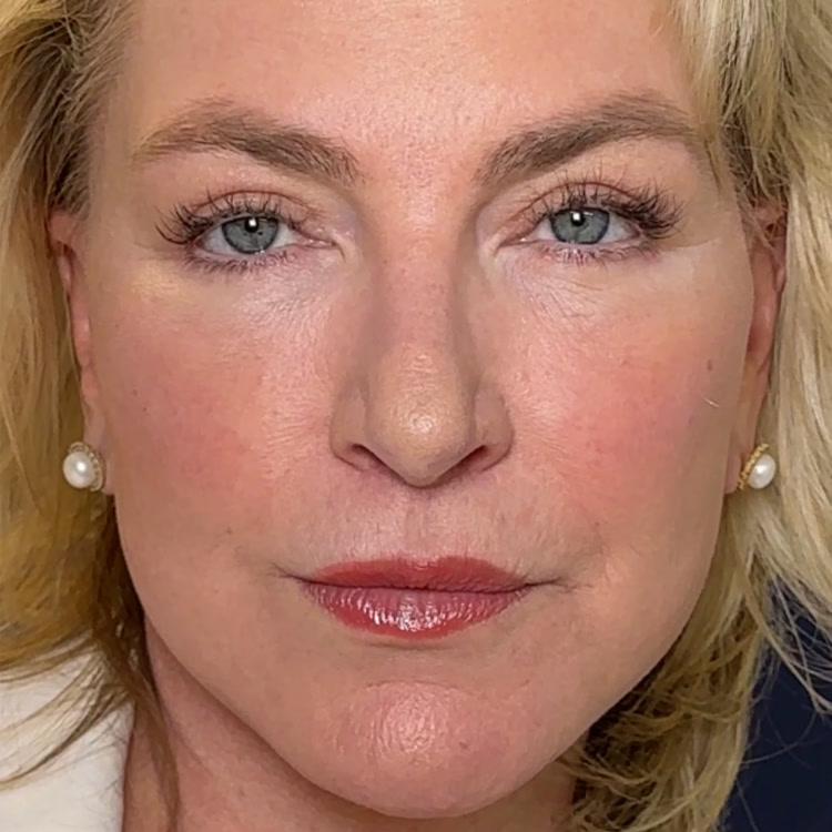 Featured patient Maria Carlsson before and after - Lip Lift · before and after composite