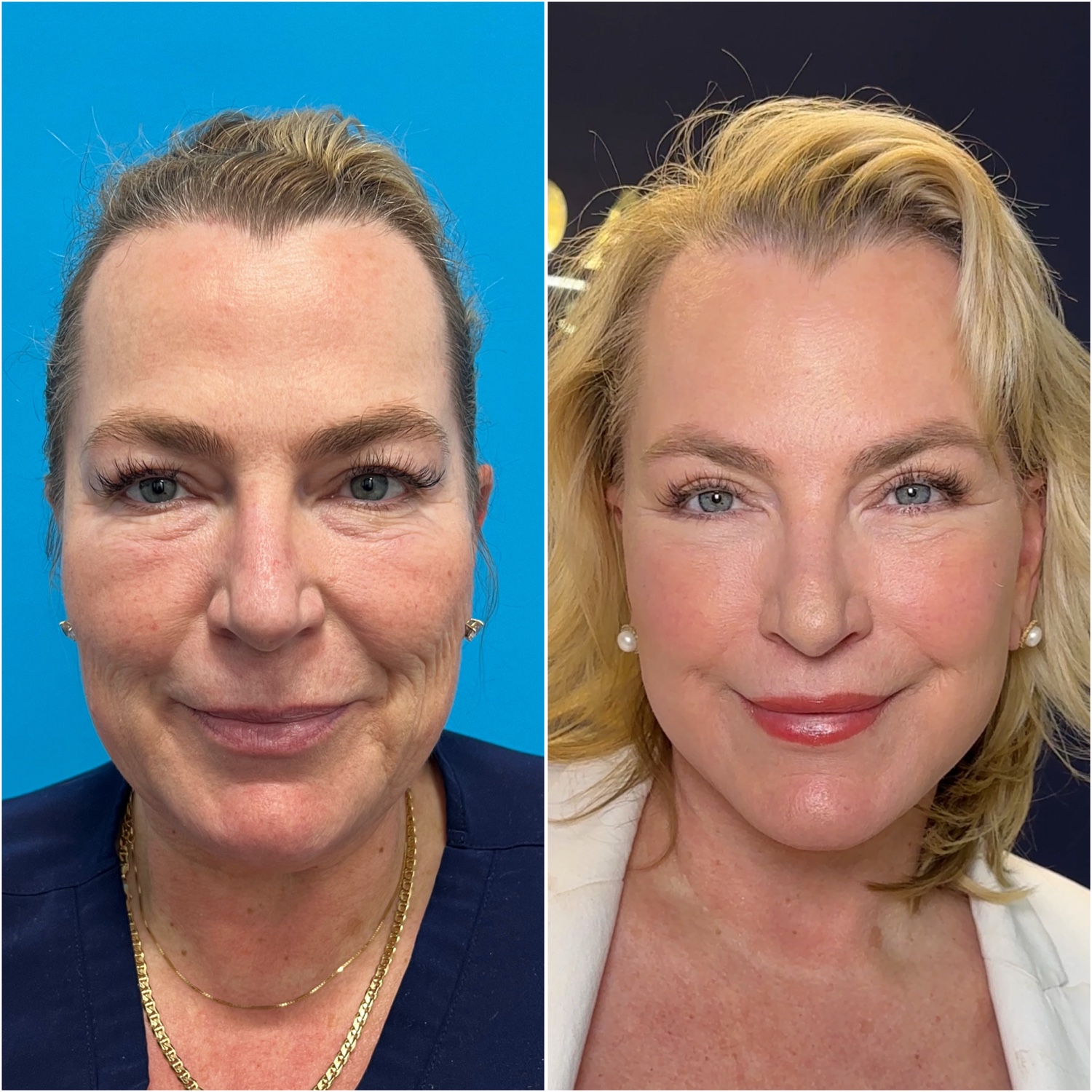 Before and after &mdash; lip lift with facelift, neck lift, upper and lower bleph, brow lift, fat transfer, buccal fat removal, and CO2 laser · before and after composite