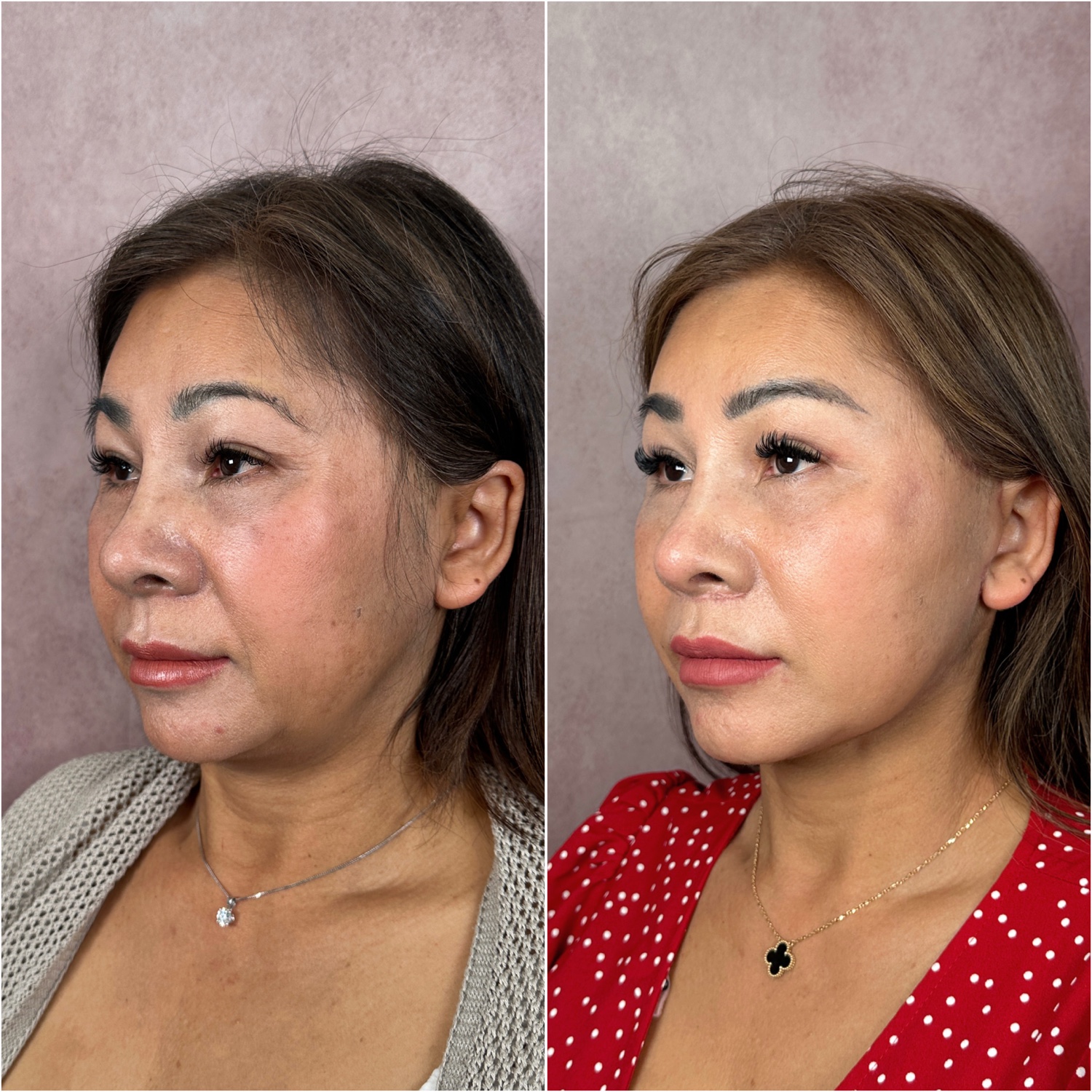 Before and after &mdash; lip lift as part of The Masterpiece, frontal view
