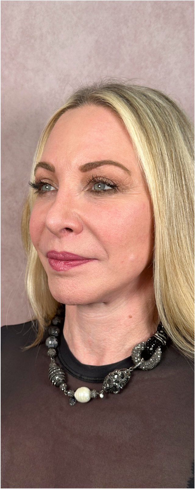 Featured patient before and after - The Masterpiece Surgery&trade; · before and after composite