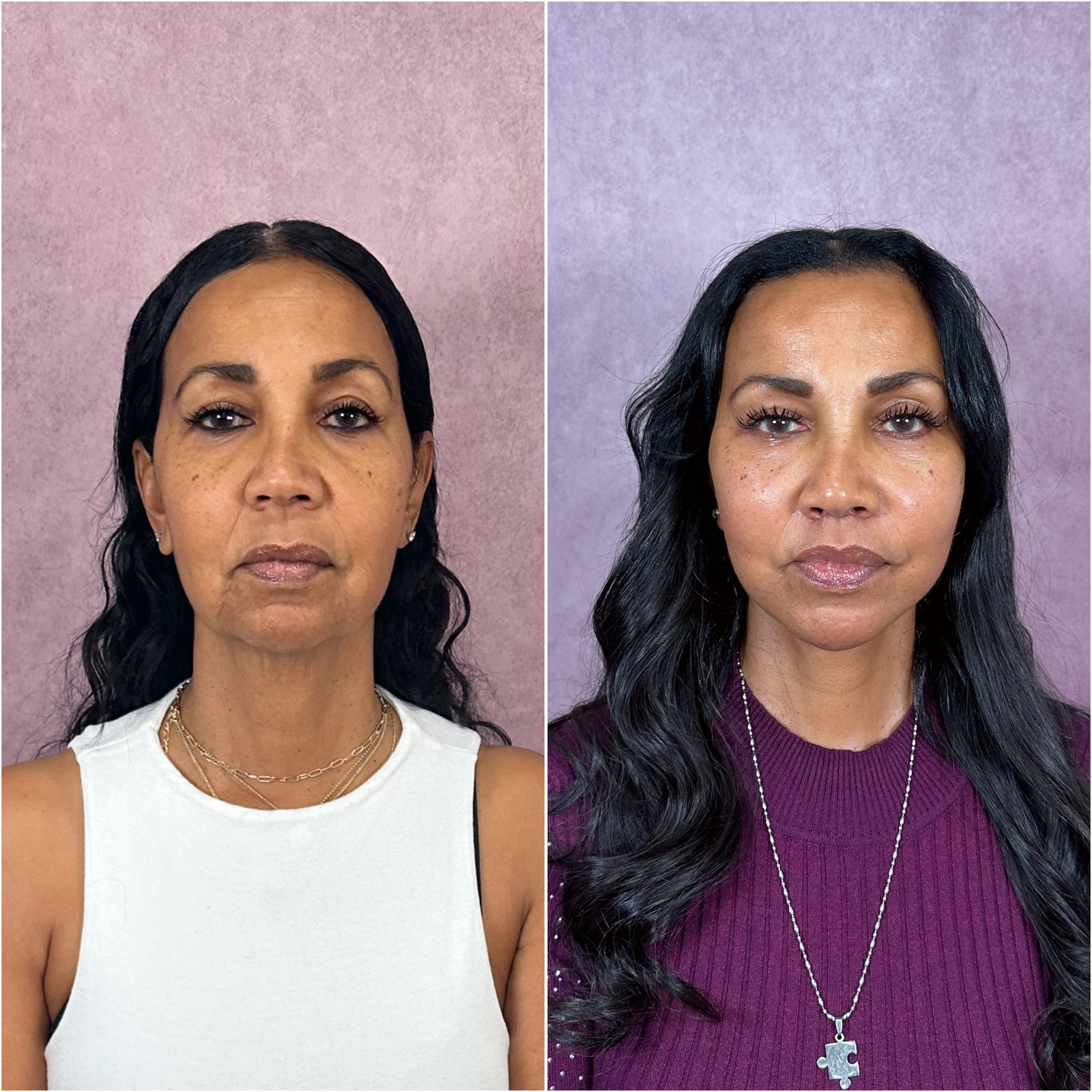 The Masterpiece Surgery&trade; patient &mdash; deep plane facelift, lip lift, and CO2 laser before and after · before and after composite