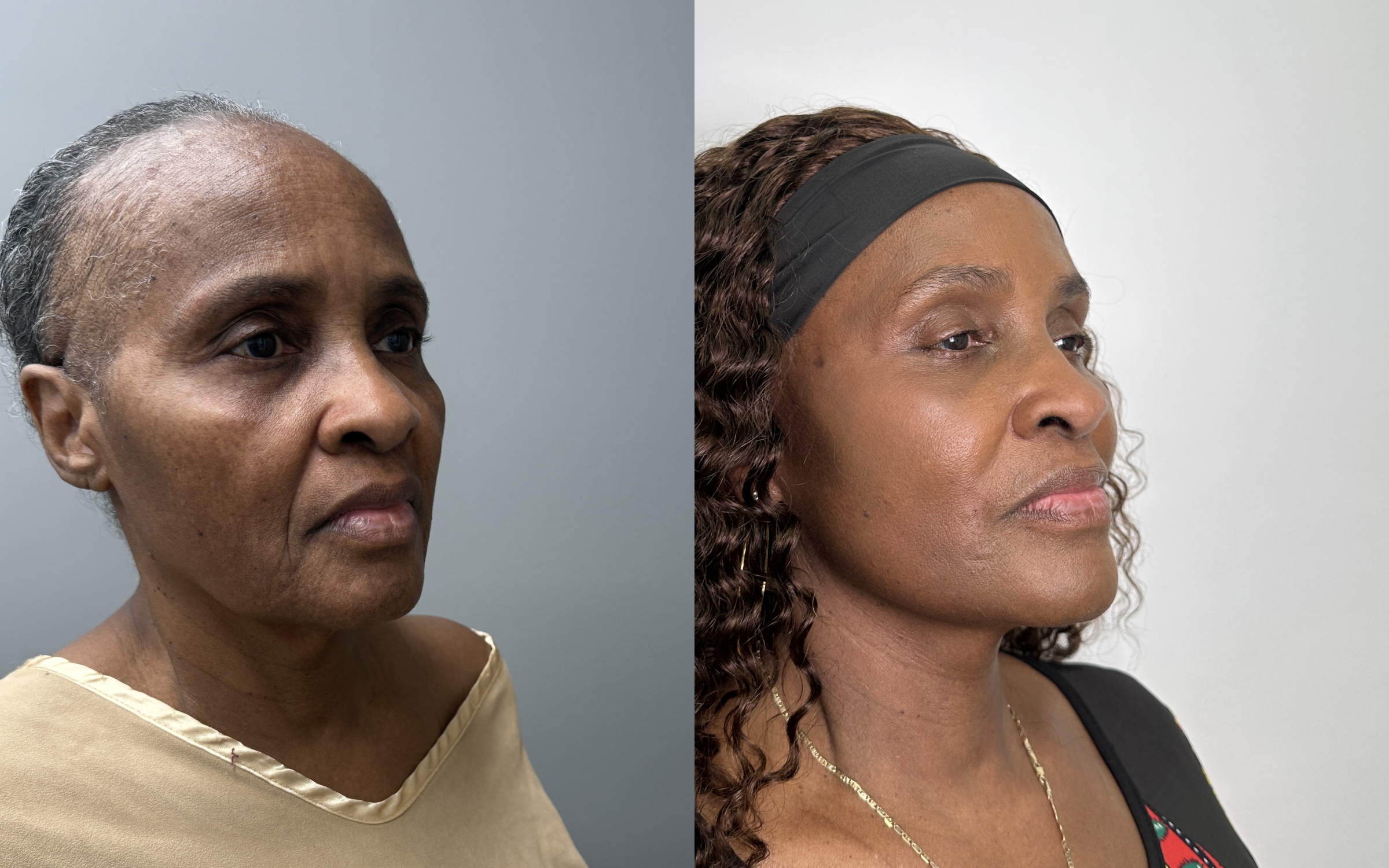 Before and after — The Masterpiece Surgery&trade;, oblique view
