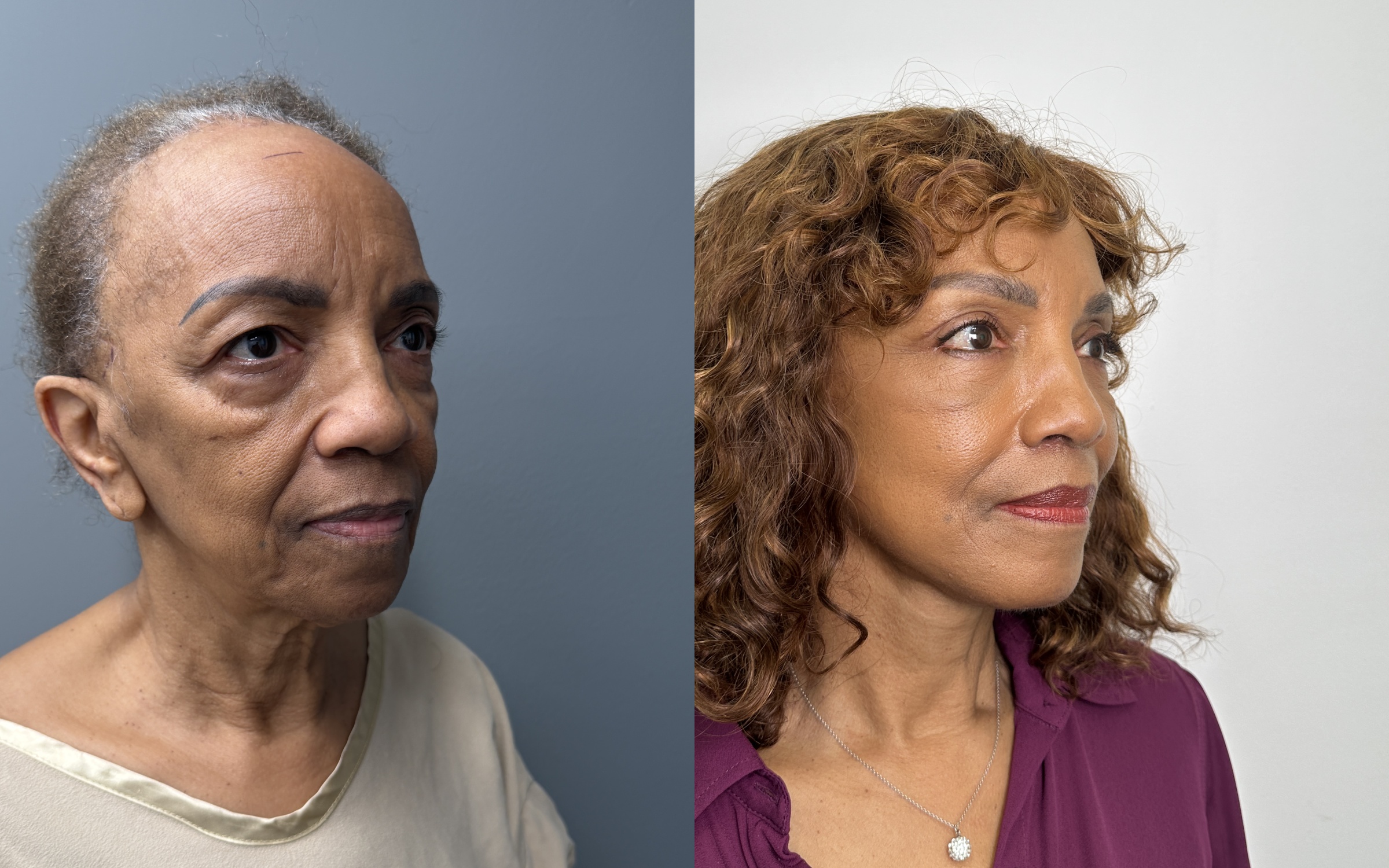 Before and after — The Masterpiece Surgery&trade;, oblique view