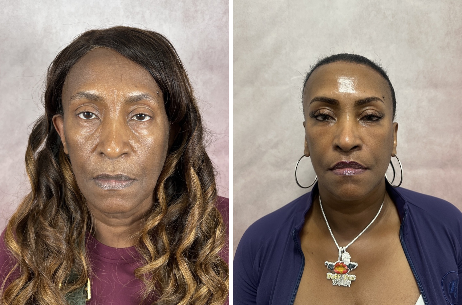 Before and after &mdash; The Masterpiece Surgery&trade;, frontal view