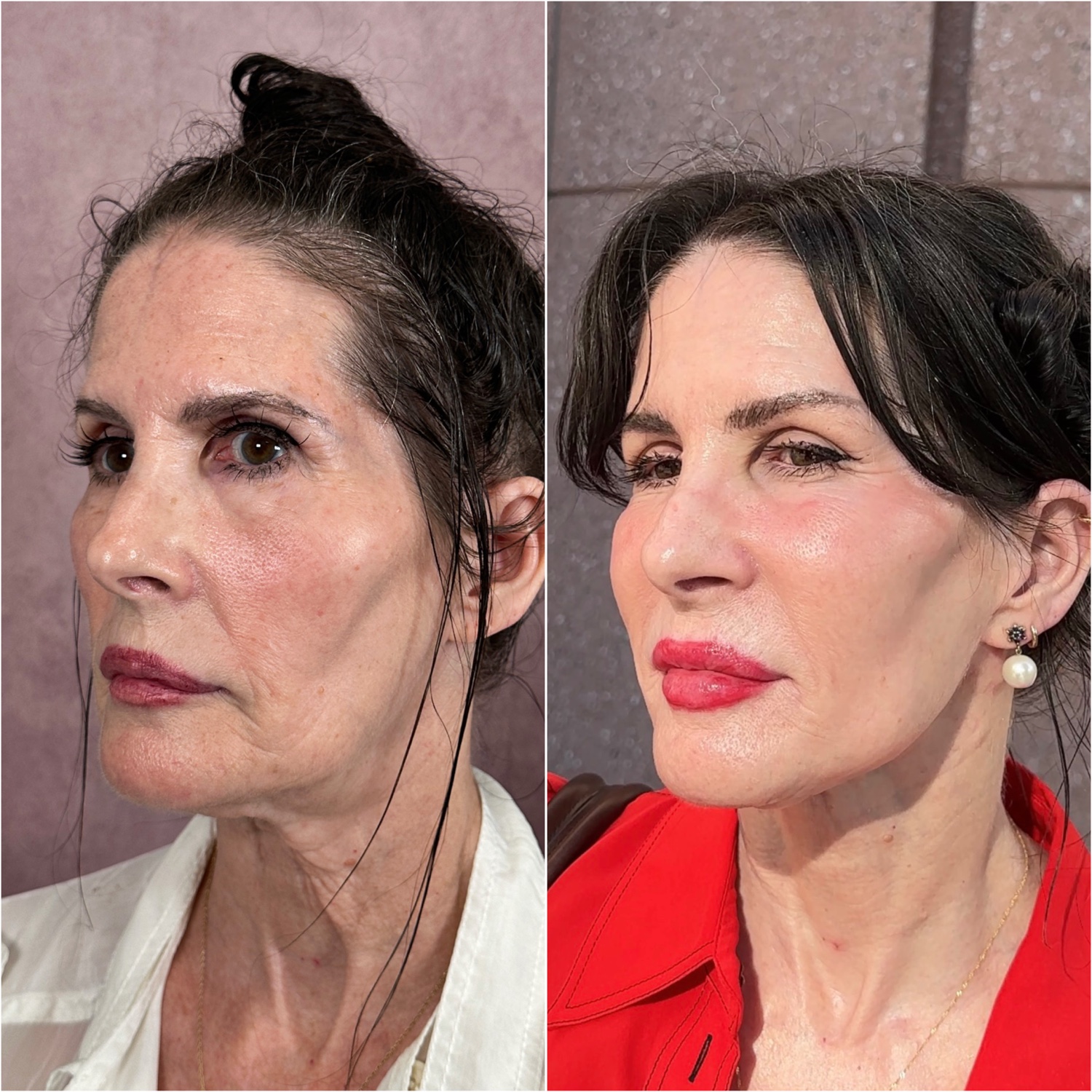 Before and after &mdash; The Masterpiece Surgery&trade;, oblique view