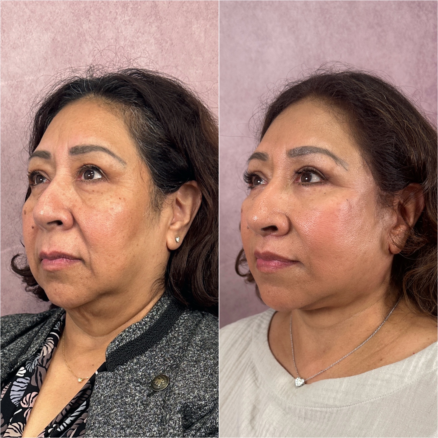 Before and after &mdash; The Masterpiece Surgery&trade;, oblique view