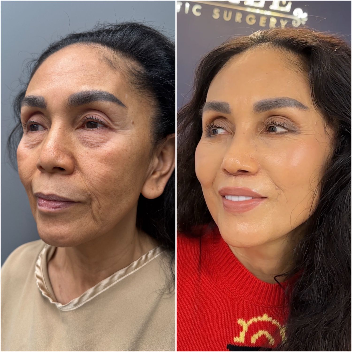 Before and after &mdash; The Masterpiece Surgery&trade;, oblique view