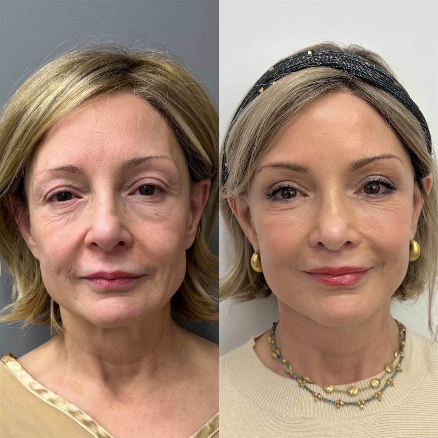 Before and after &mdash; The Masterpiece Surgery&trade;, frontal view