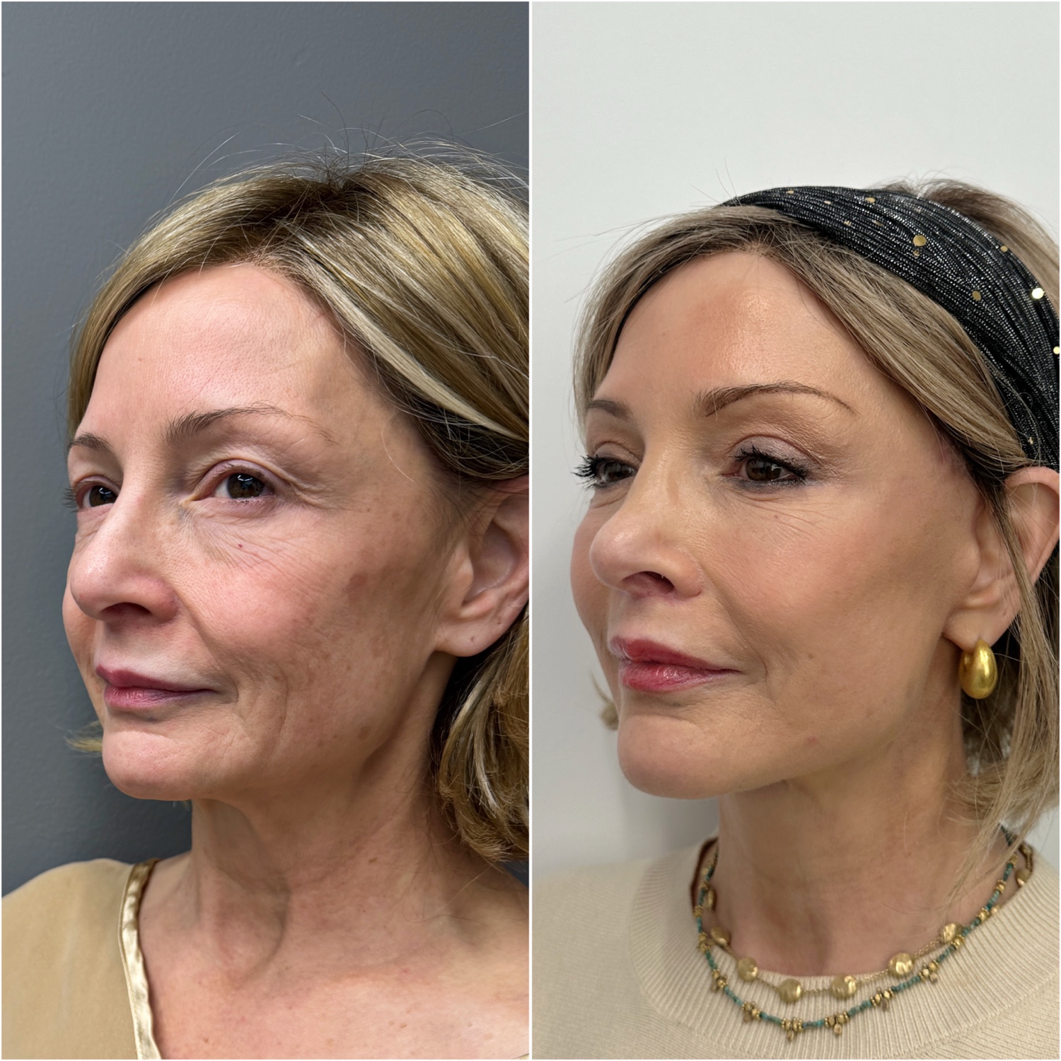 Before and after &mdash; The Masterpiece Surgery&trade;, oblique view