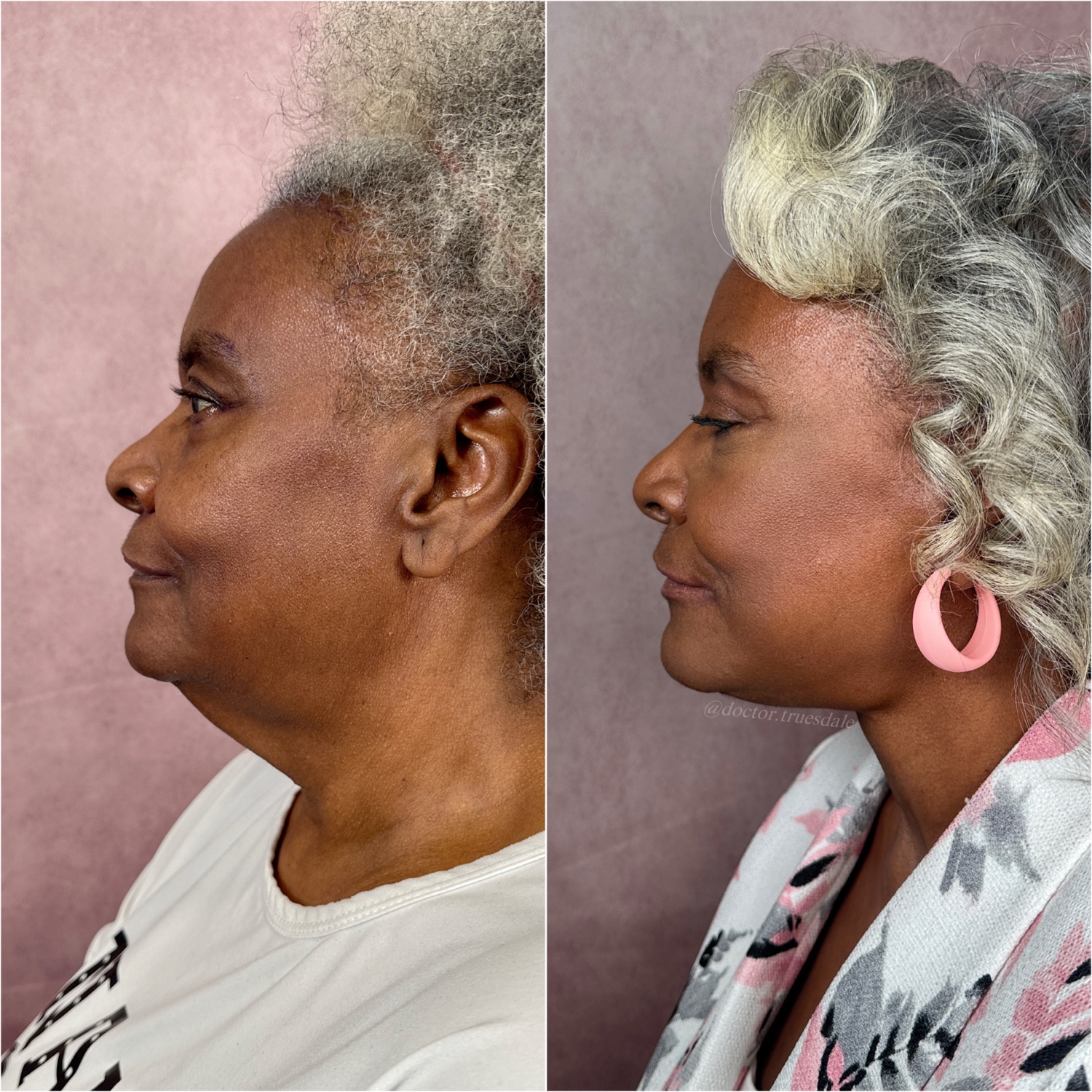 Before and after &mdash; The Masterpiece Surgery&trade;, profile view