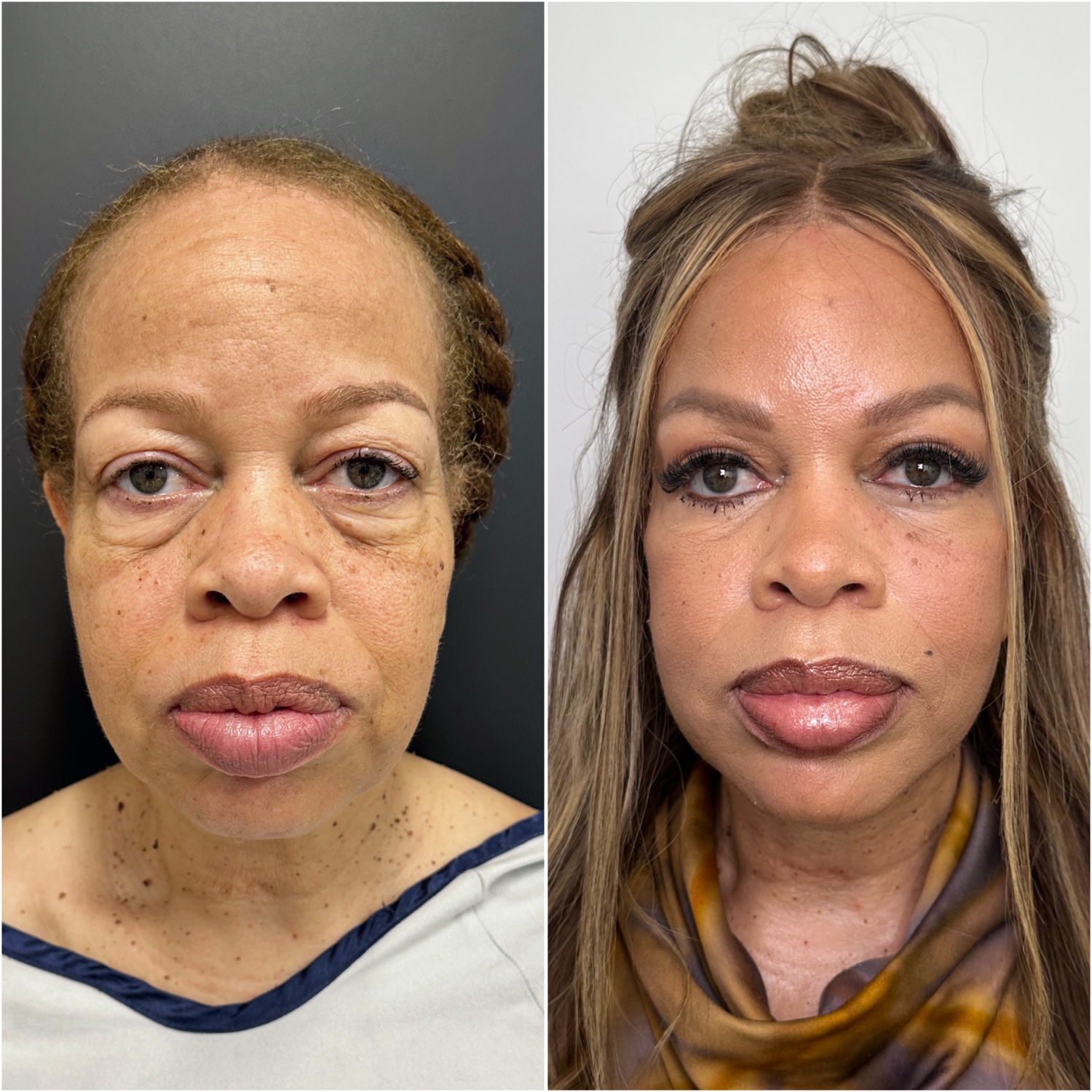 Before and after &mdash; The Masterpiece Surgery&trade;, frontal view
