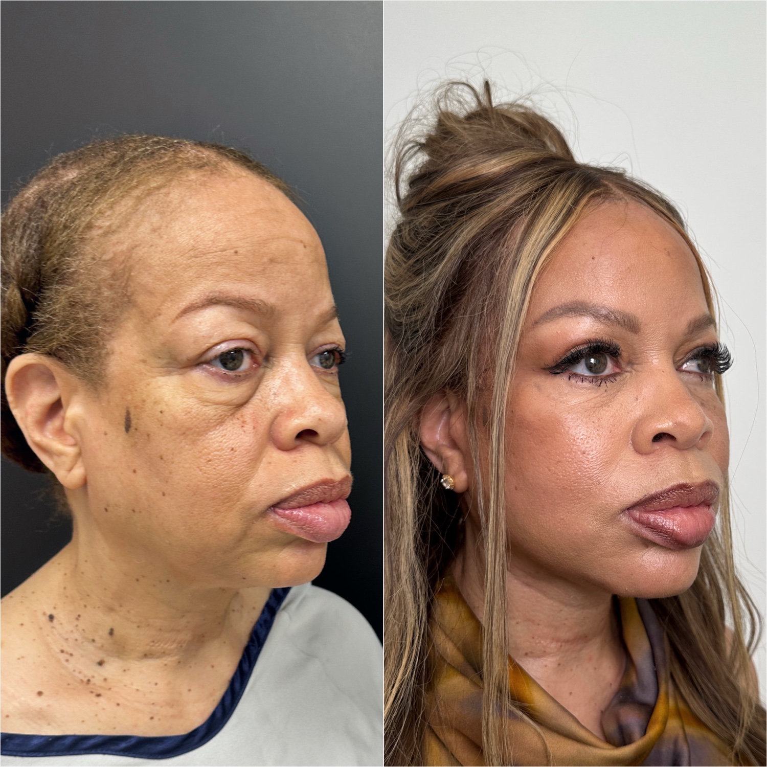 Before and after &mdash; The Masterpiece Surgery&trade;, oblique view