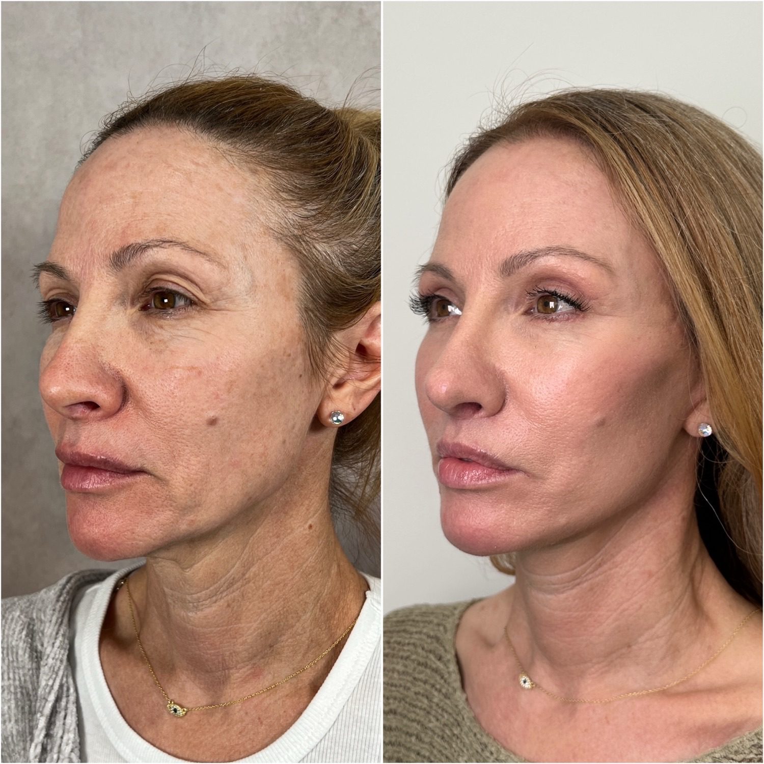Before and after &mdash; The Masterpiece Surgery&trade;: deep plane facelift, deep neck lift, brow lift, upper blepharoplasty, lower lid skin pinch, lip lift, fat transfer, CO2 laser resurfacing and revision rhinoplasty, opposite oblique view