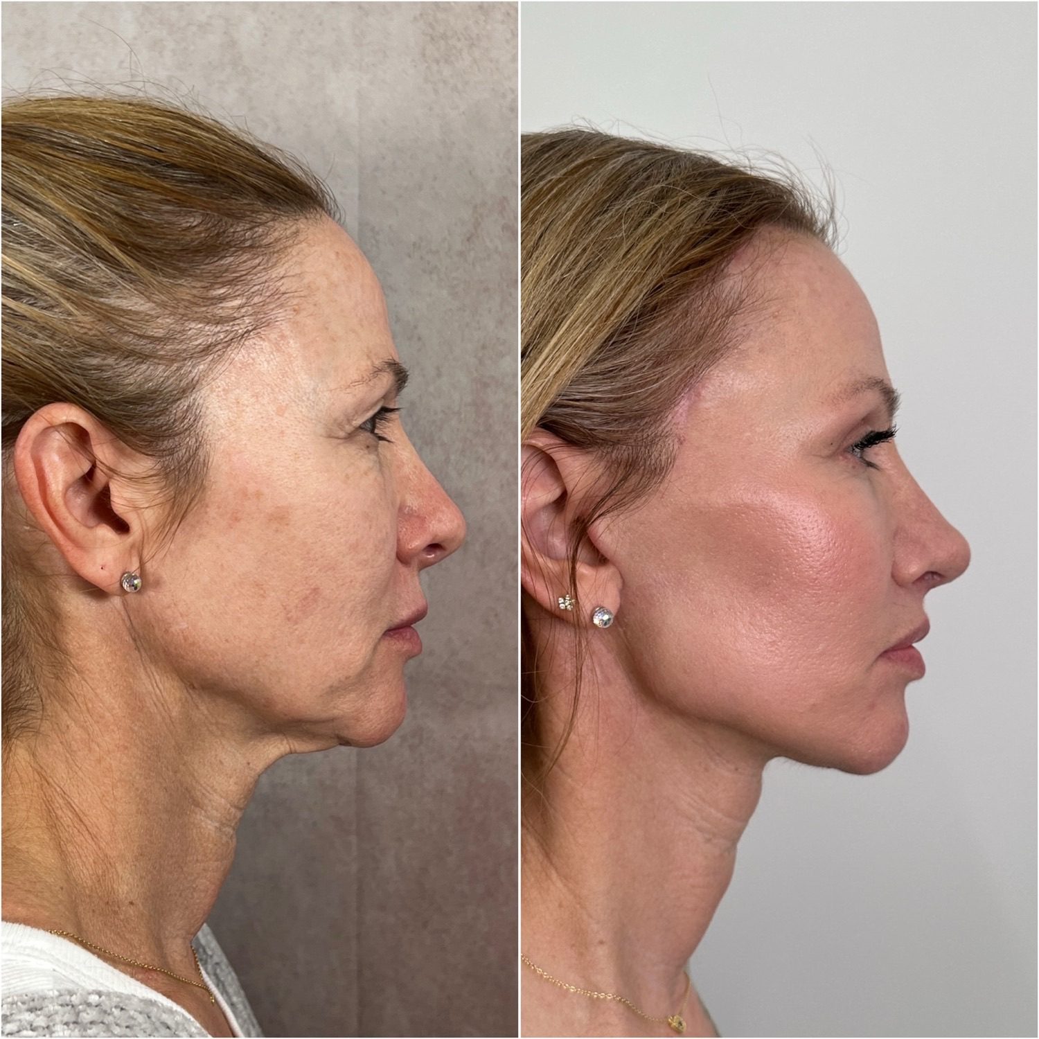 Before and after &mdash; The Masterpiece Surgery&trade;: deep plane facelift, deep neck lift, brow lift, upper blepharoplasty, lower lid skin pinch, lip lift, fat transfer, CO2 laser resurfacing and revision rhinoplasty, profile view
