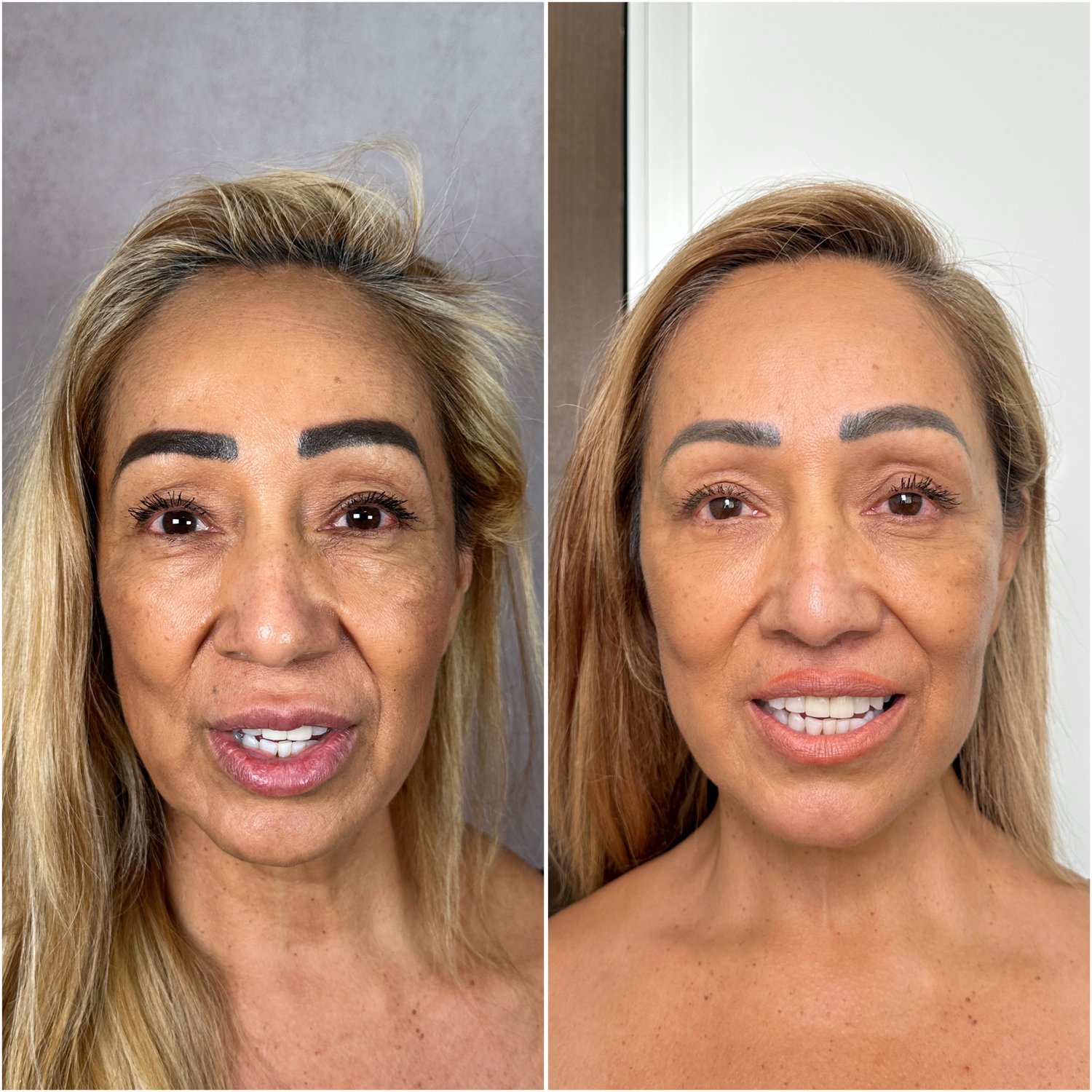 Deep Plane Facelift & Neck Lift before and after · frontal view