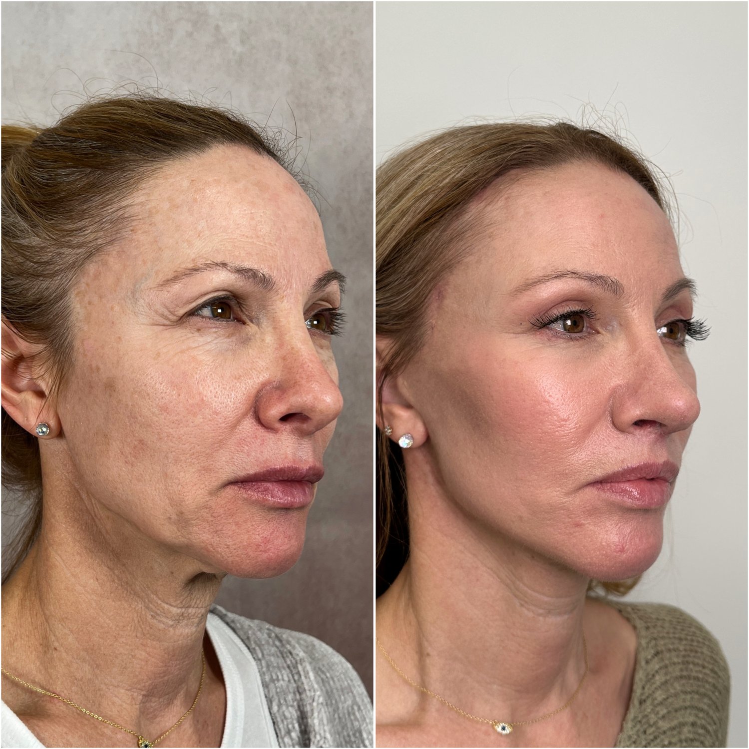 Before and after &mdash; The Masterpiece Surgery&trade;, oblique view