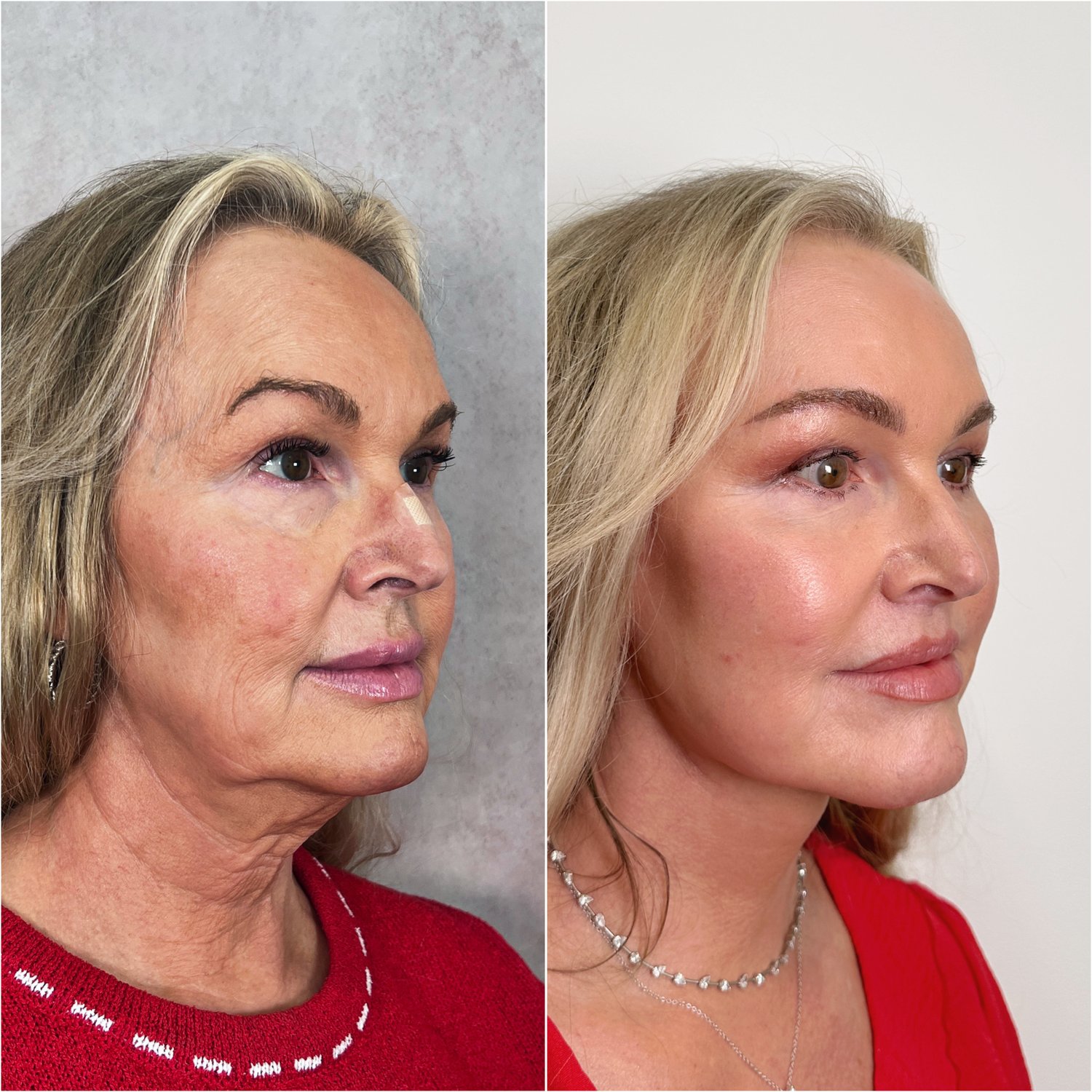 Before and after &mdash; The Masterpiece Surgery&trade;, opposite oblique view