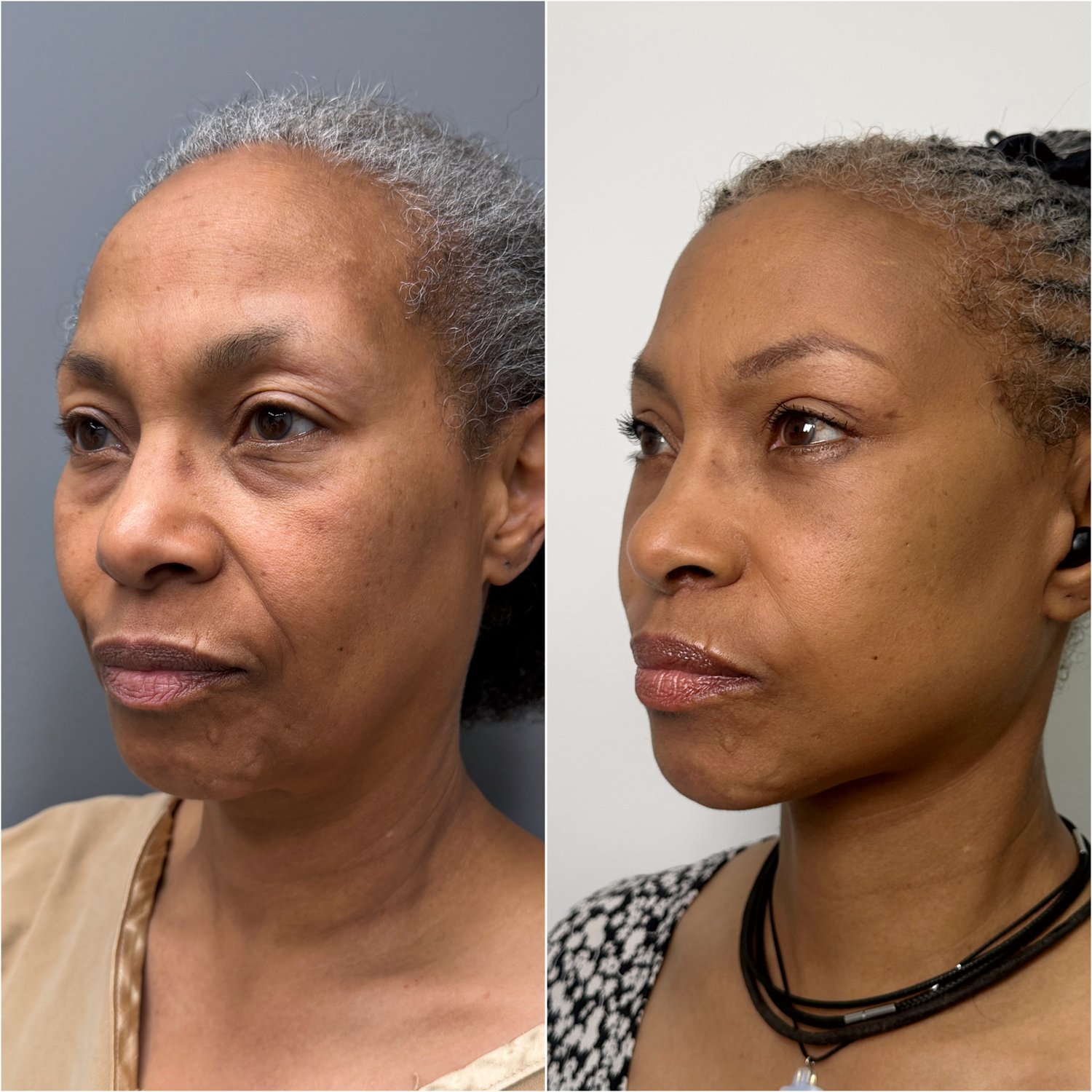 Before and after &mdash; The Masterpiece Surgery&trade;, oblique view