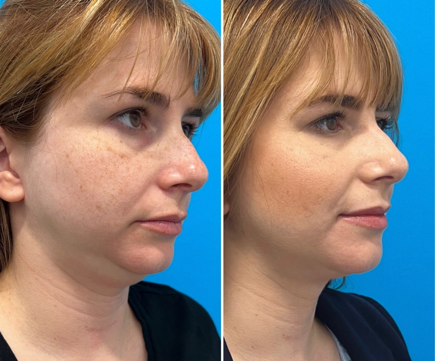 Neck liposuction before and after · before and after composite