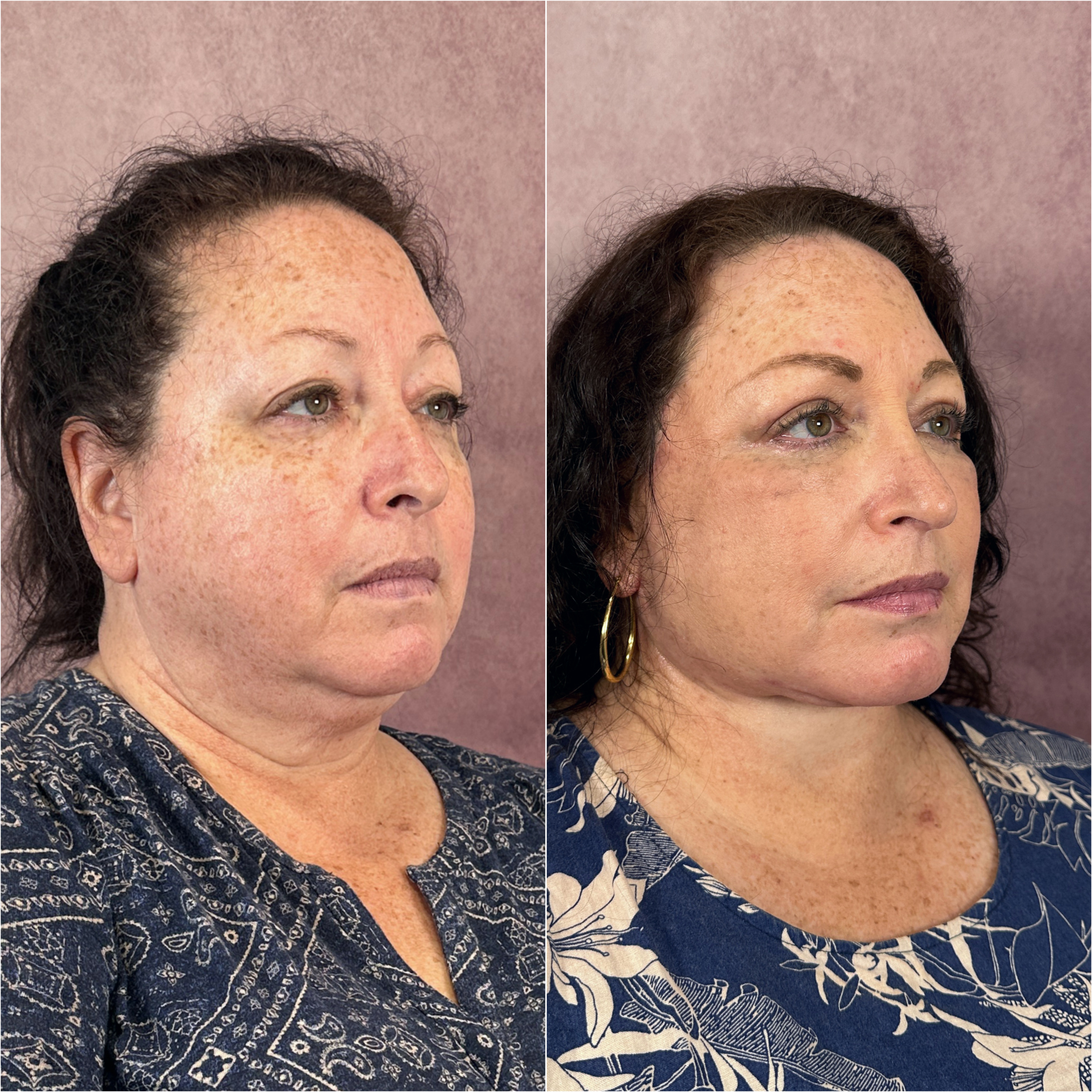 Deep neck lift as part of The Masterpiece Surgery&trade; &mdash; featured patient